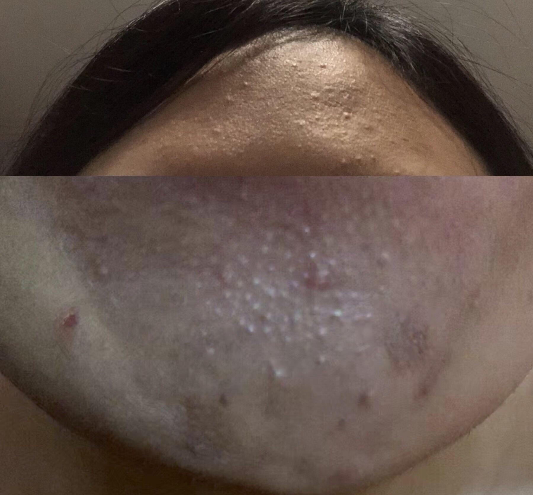 [routine help] How can I get rid of these bumps on my forehead and chin