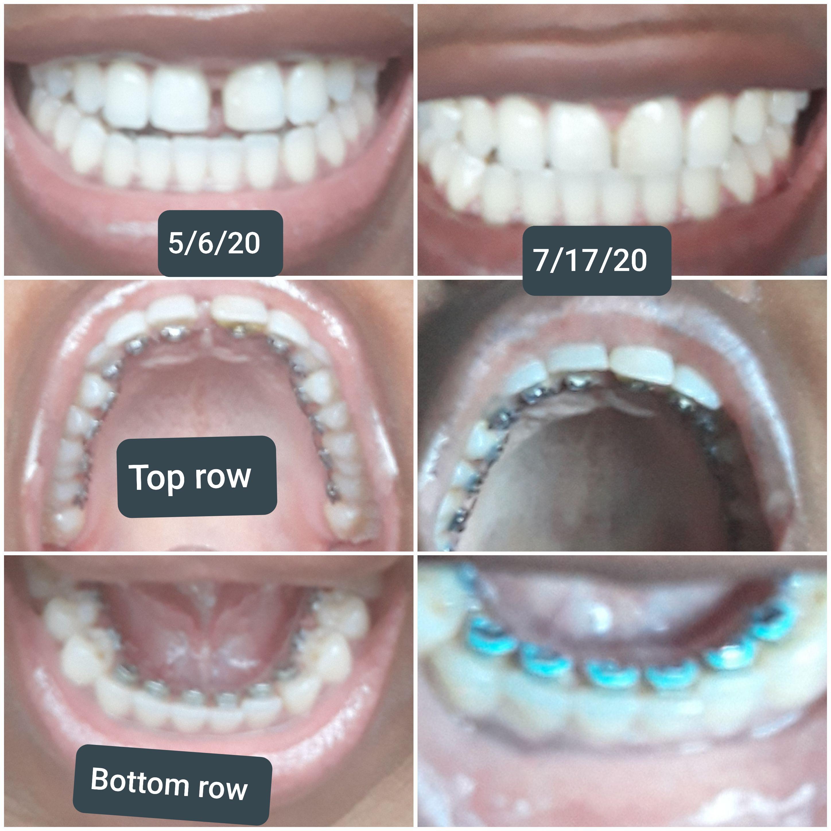 My Inbrace lingual braces progress; 5/67/17. I feel and look odd that