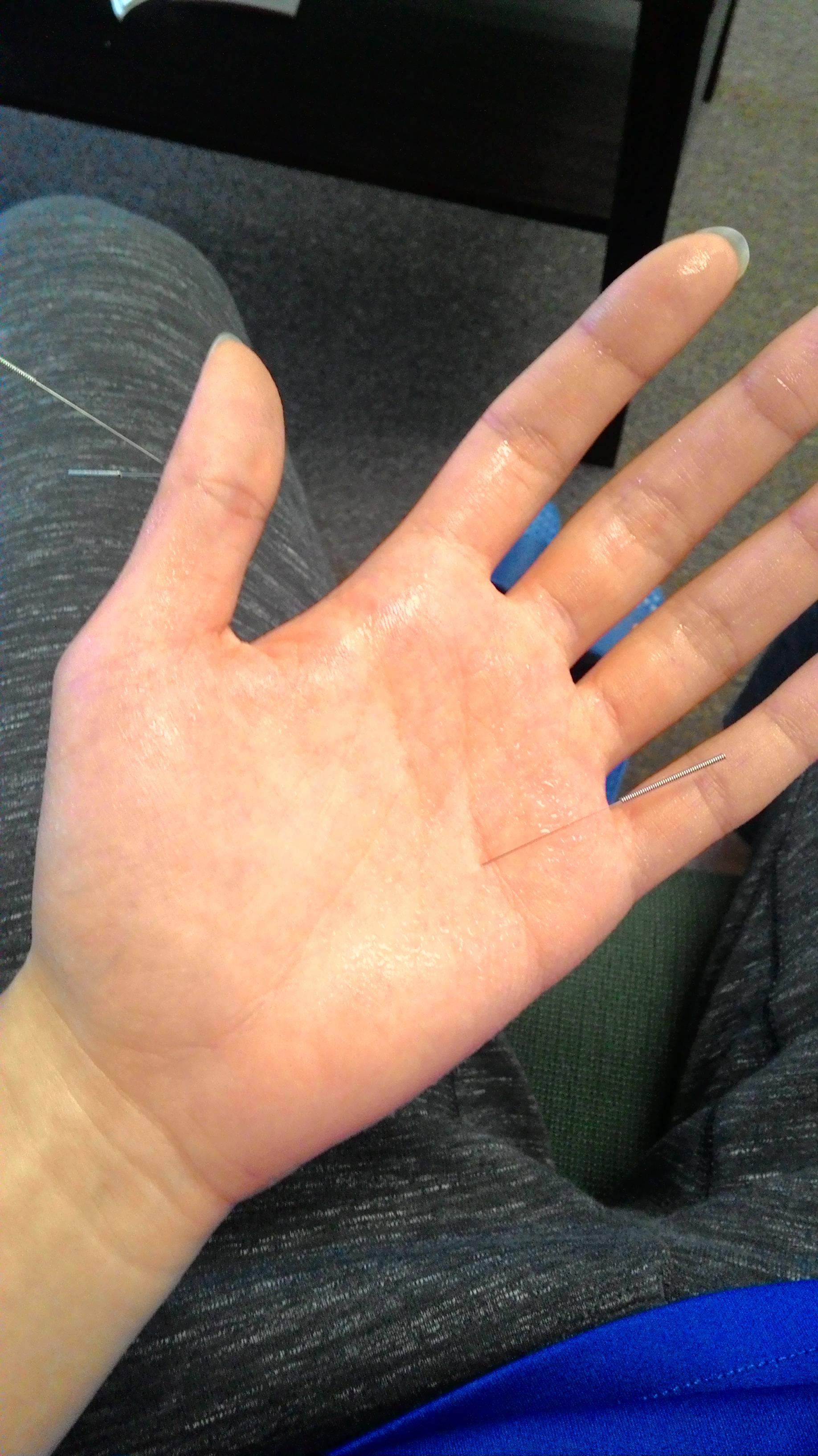 So i went for acupuncture today... r/Hyperhidrosis