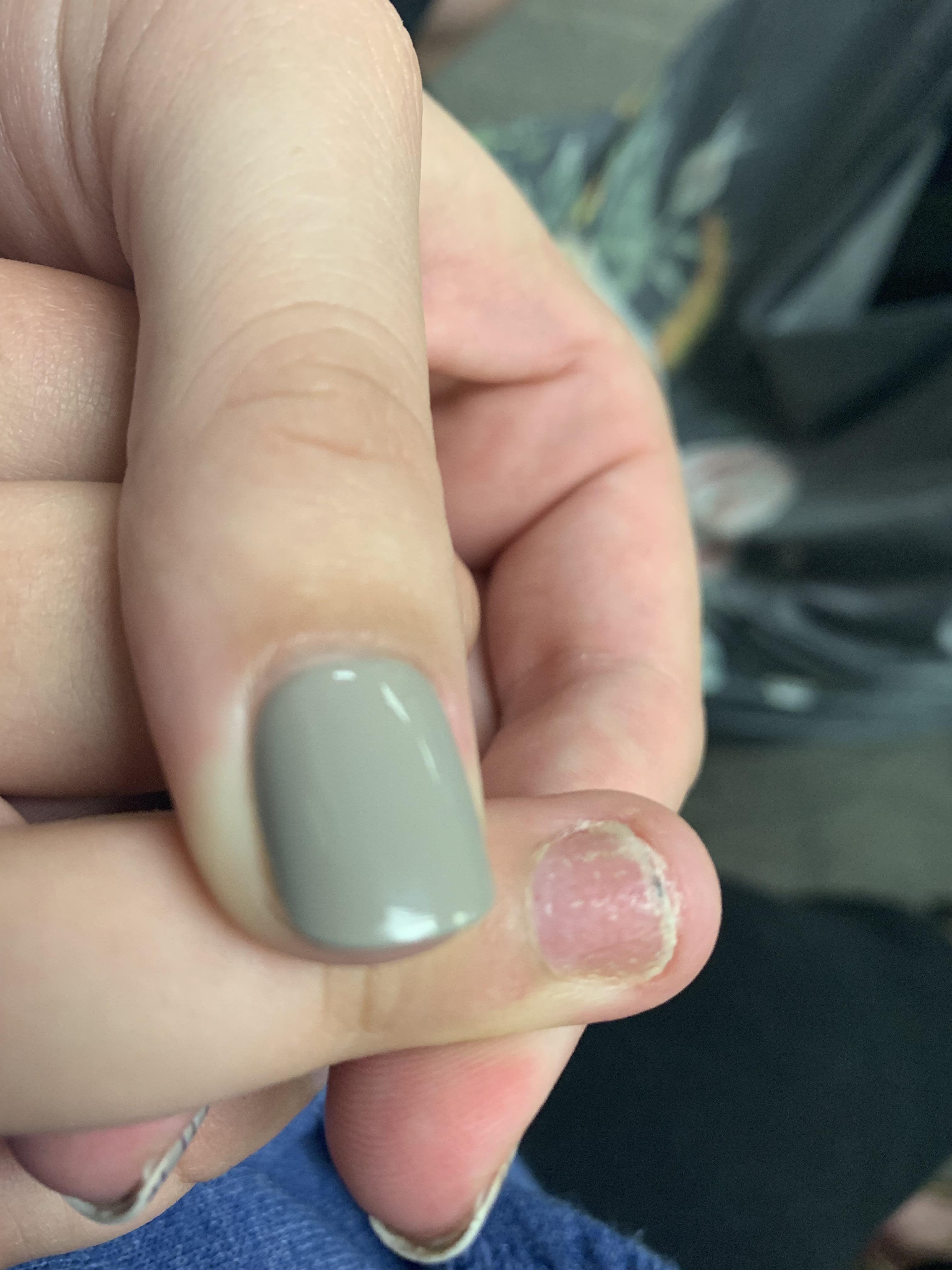 Pitted nail on 9 year old no injury, no pain. Consistently grows like