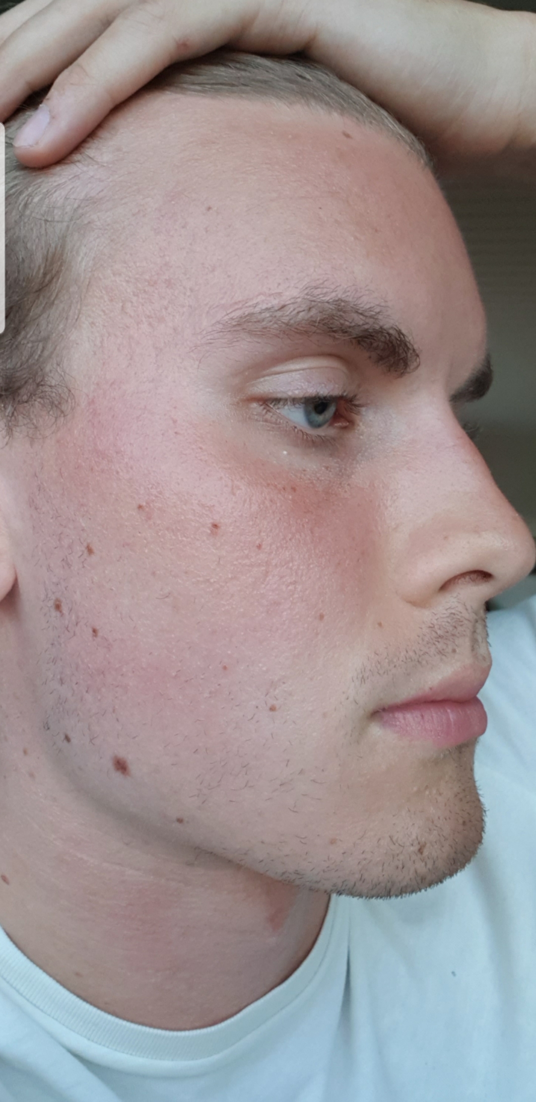 Still extremely dry/dehydrated skin 1,5 year post accutane (help) r/Accutane