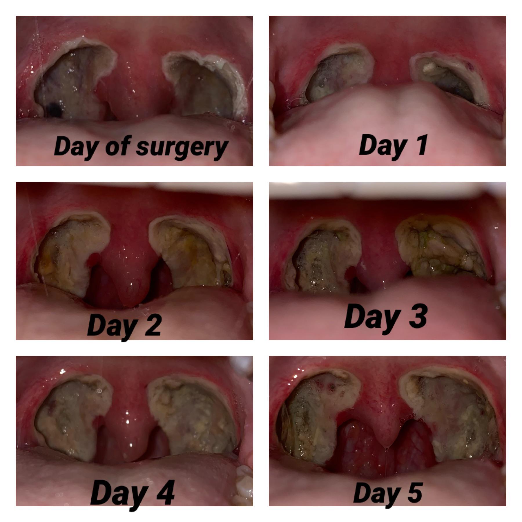 Tonsillectomy Recovery Pics (Day 05) r/tonsilstones