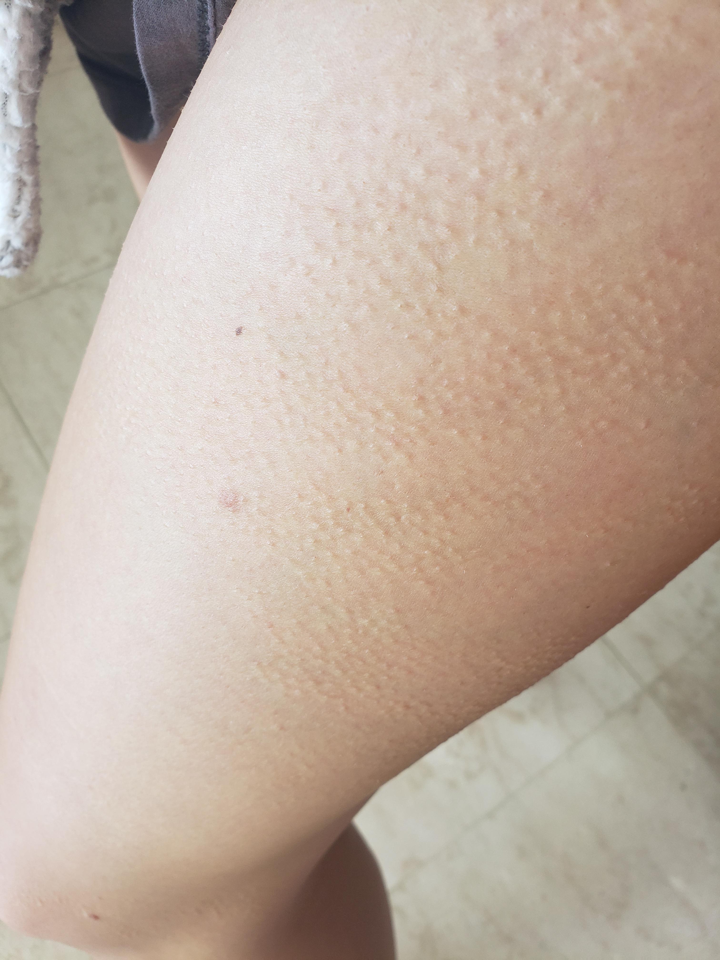 I am getting random goosebumps on my leg when I'm not cold. Don't know