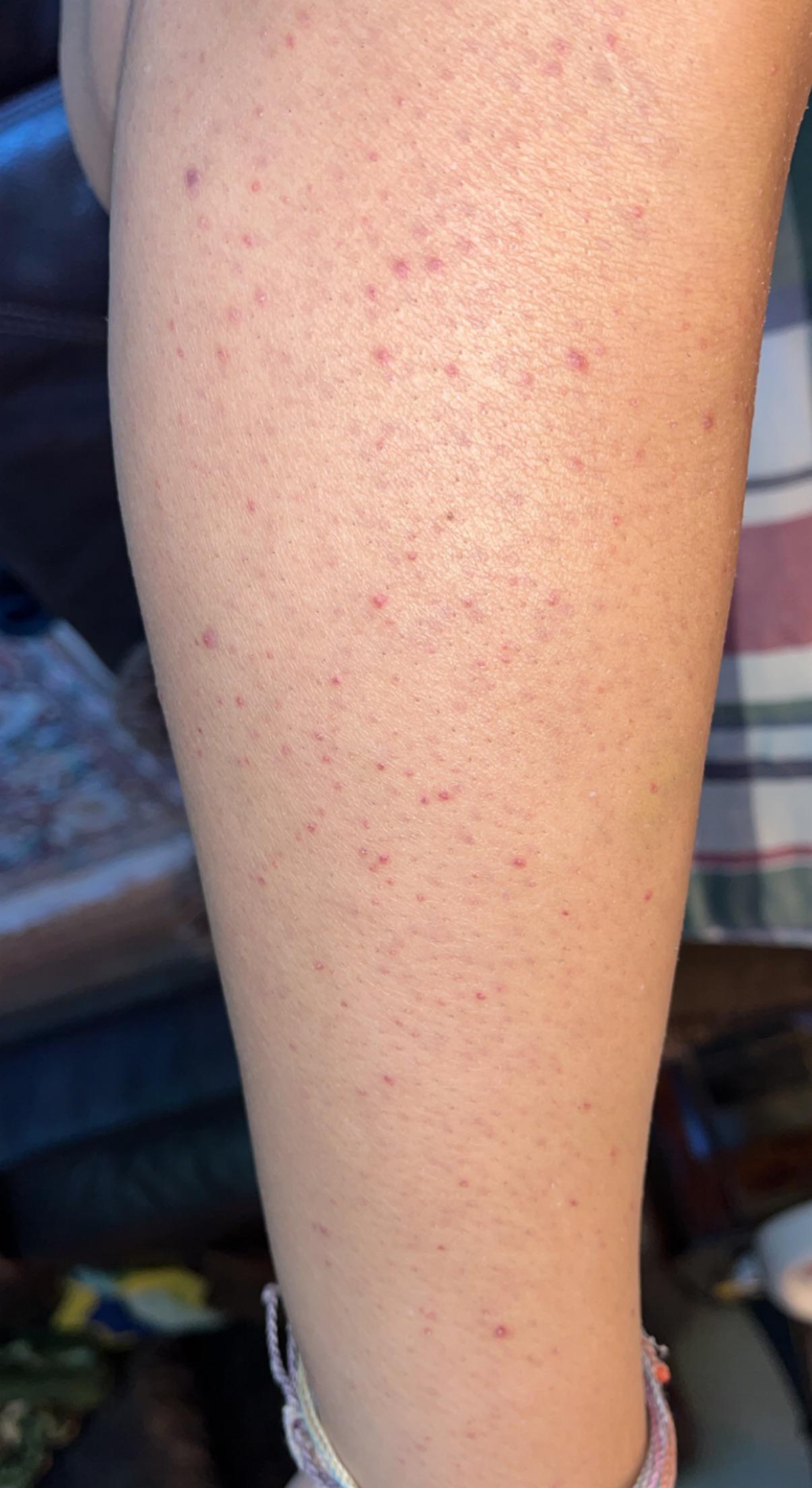[Skin Concern] Any advice for my legs? Is it ‘strawberry legs’? r