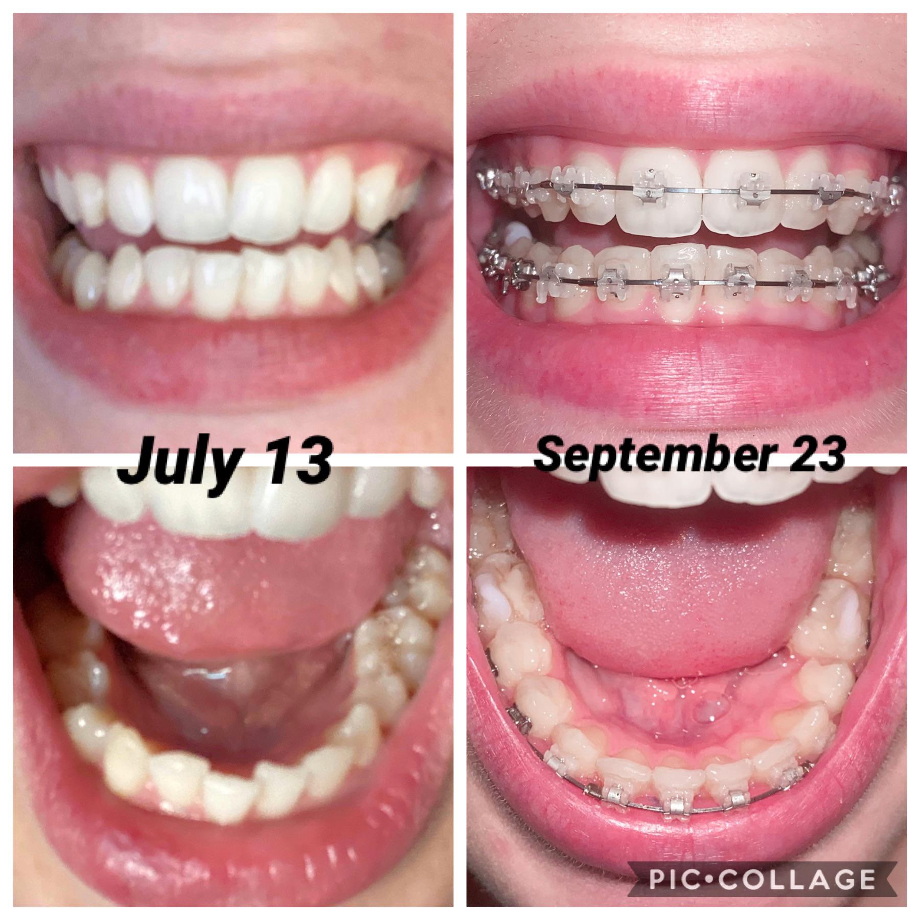 10 week progress! I had my first tightening yesterday ) r/braces