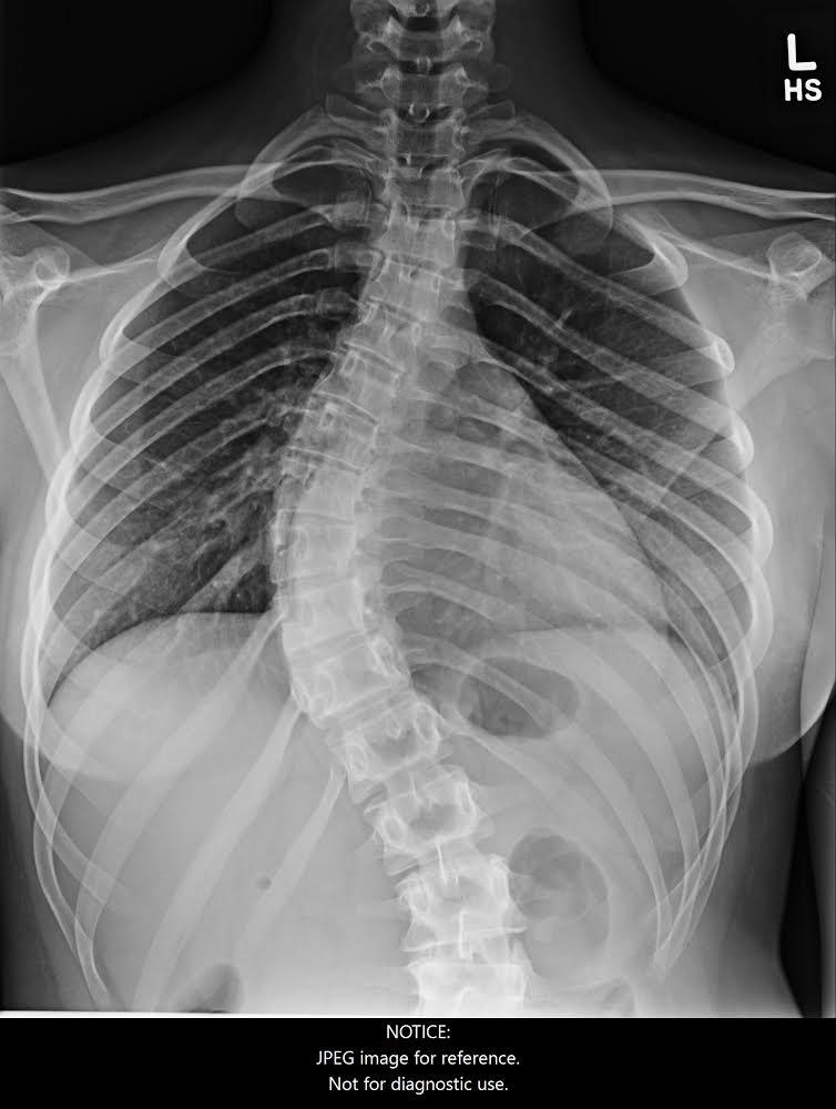 Struggling Student scoliosis