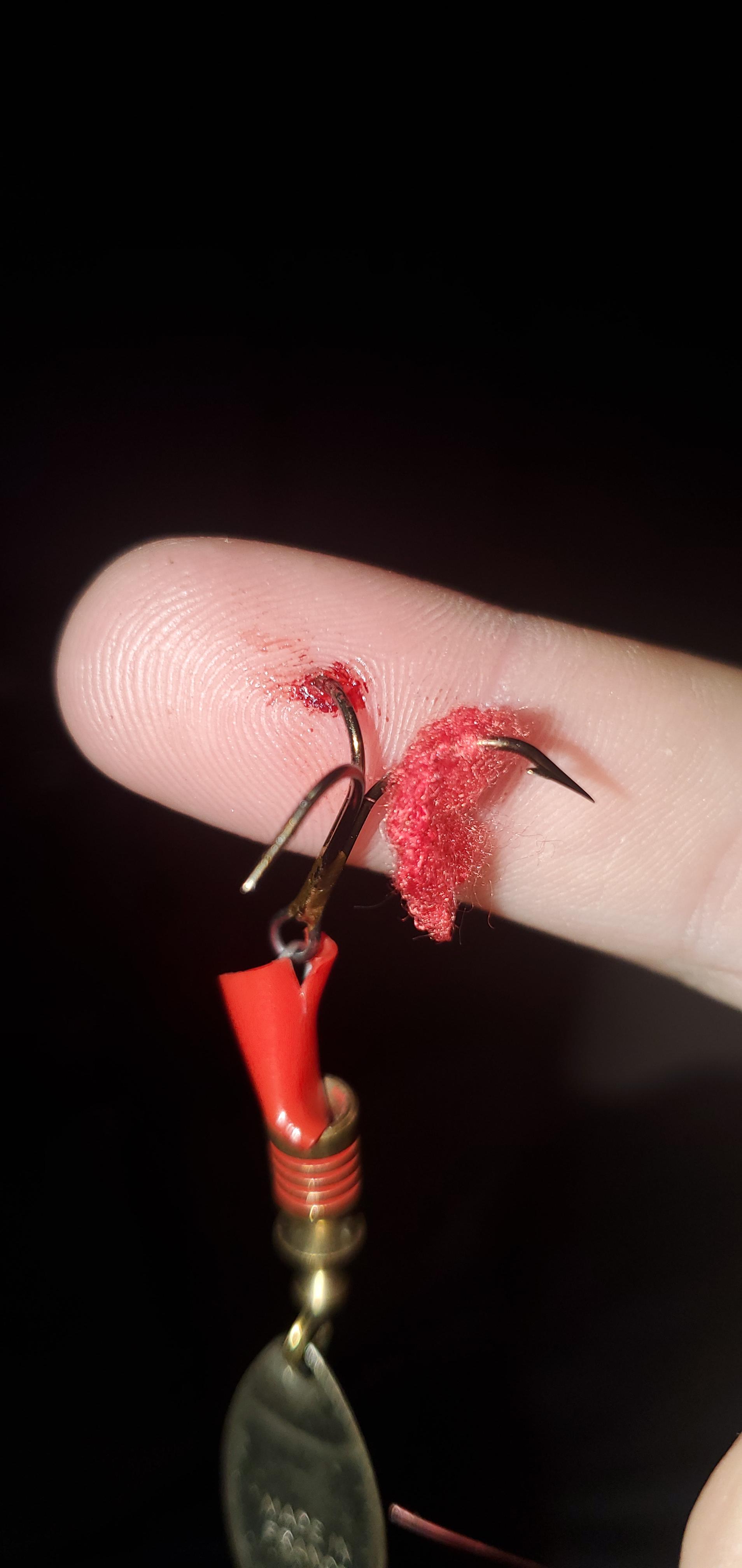 Hook stuck in hand . Help! Any ideas? r/Fishing