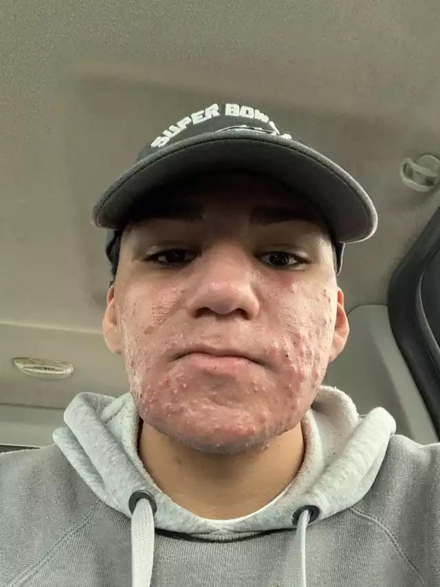 Cold sore? Accutane