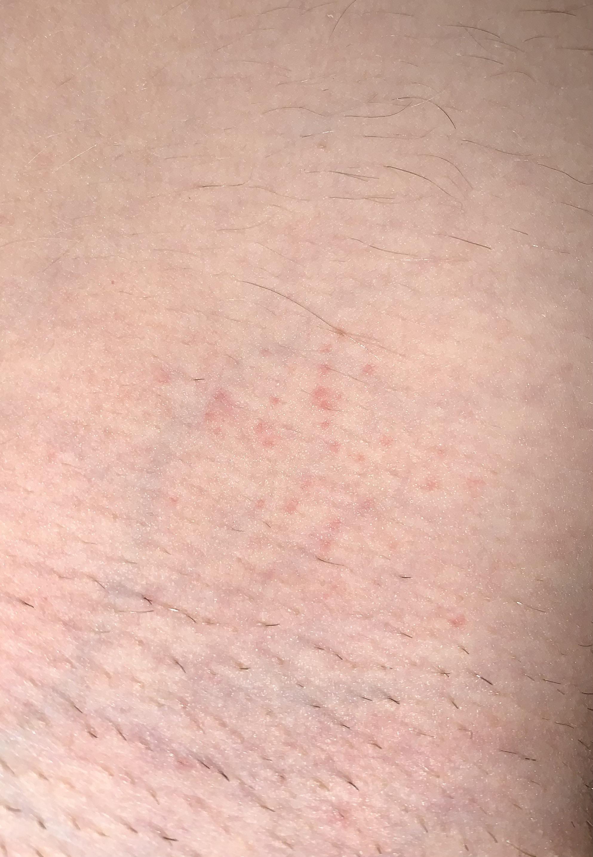 Rash on inner thigh?? r/medical_advice