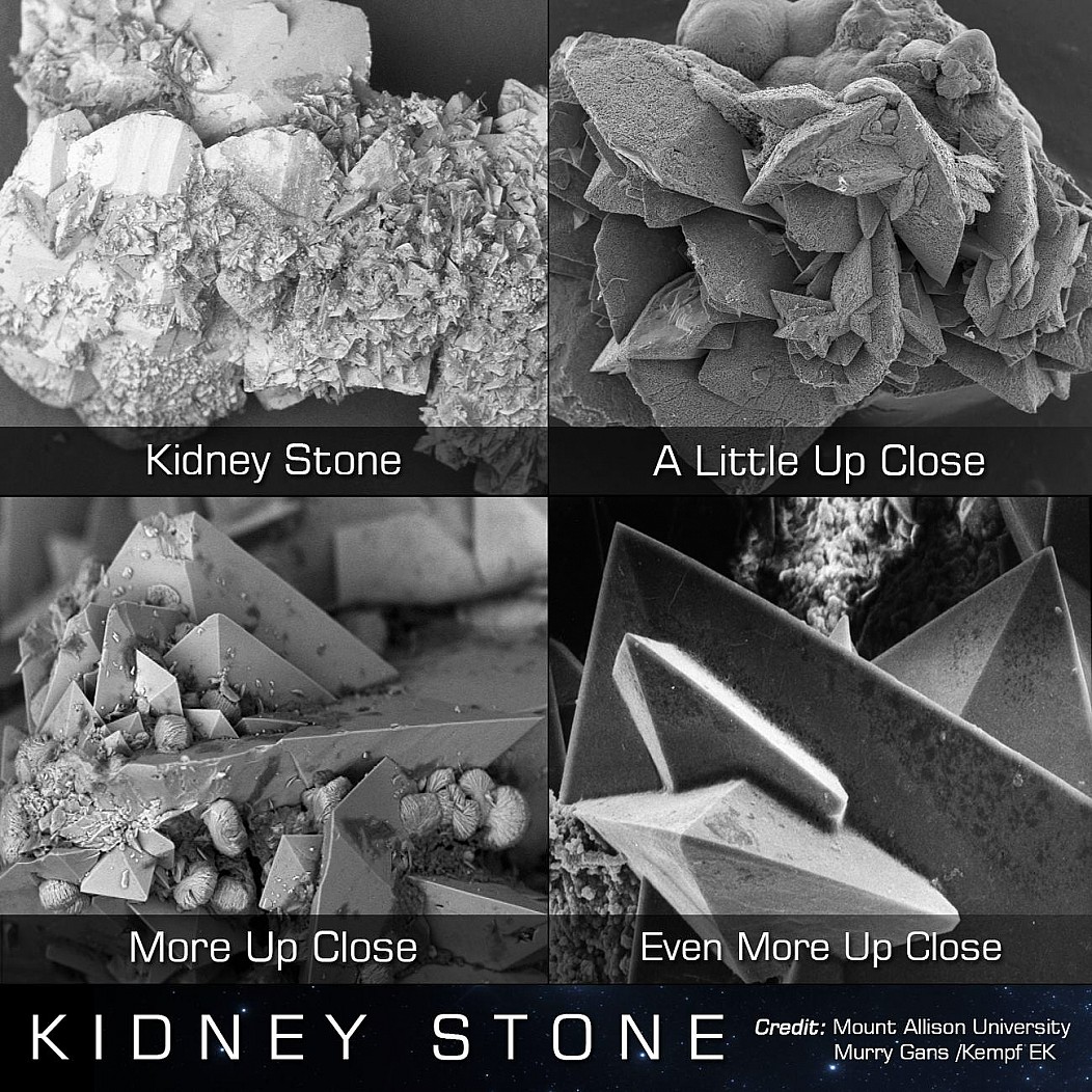 Kidney stone under a microscope r/oddlyterrifying