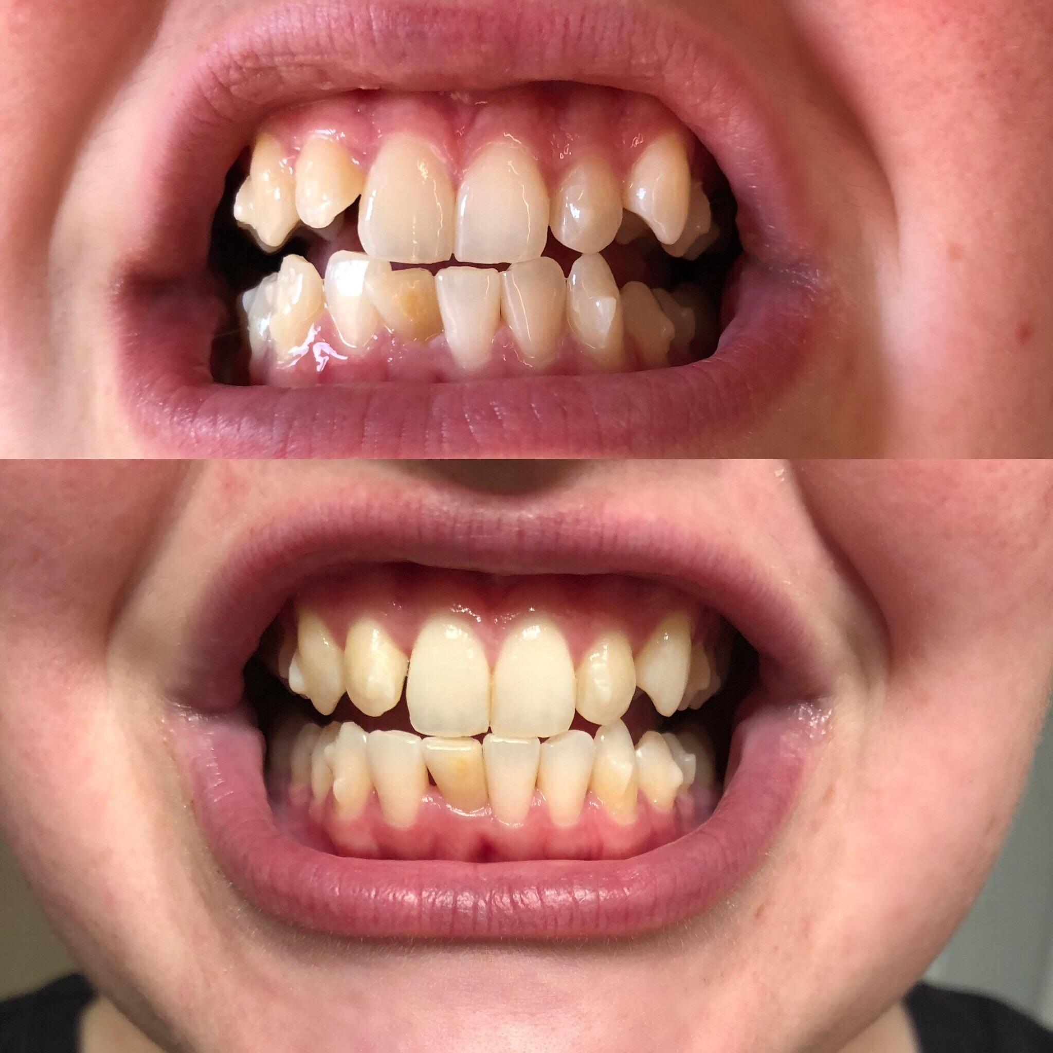 Progress from Tray 1Tray 18. Total of 31 trays with changes every 2