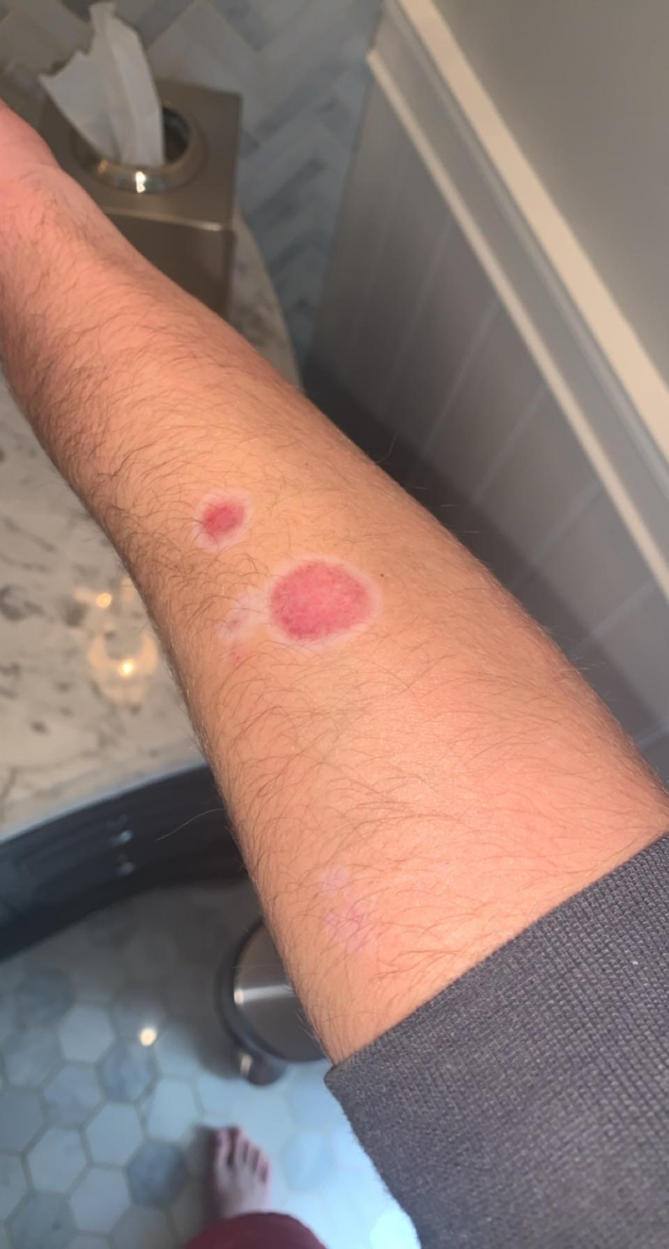 Cigar burn from 2 months ago when will this purpleness go away??? r