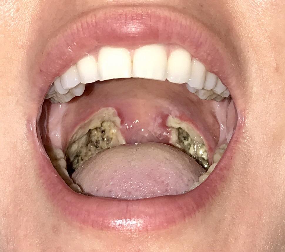 How To Cough Up Tonsil Stones Reddit bronchitis contagious