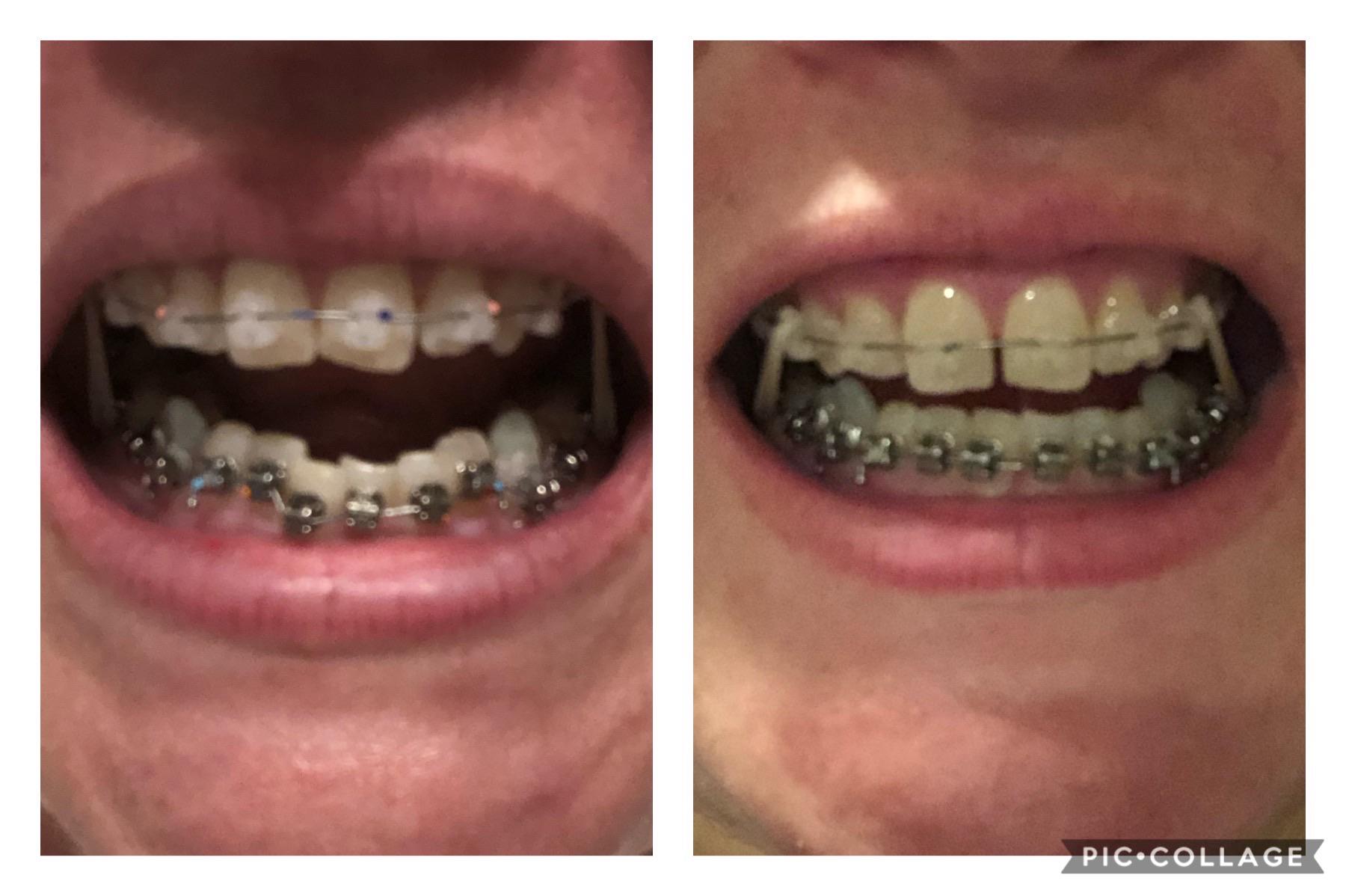 Day 1 vs. first adjustment at week 10! r/braces