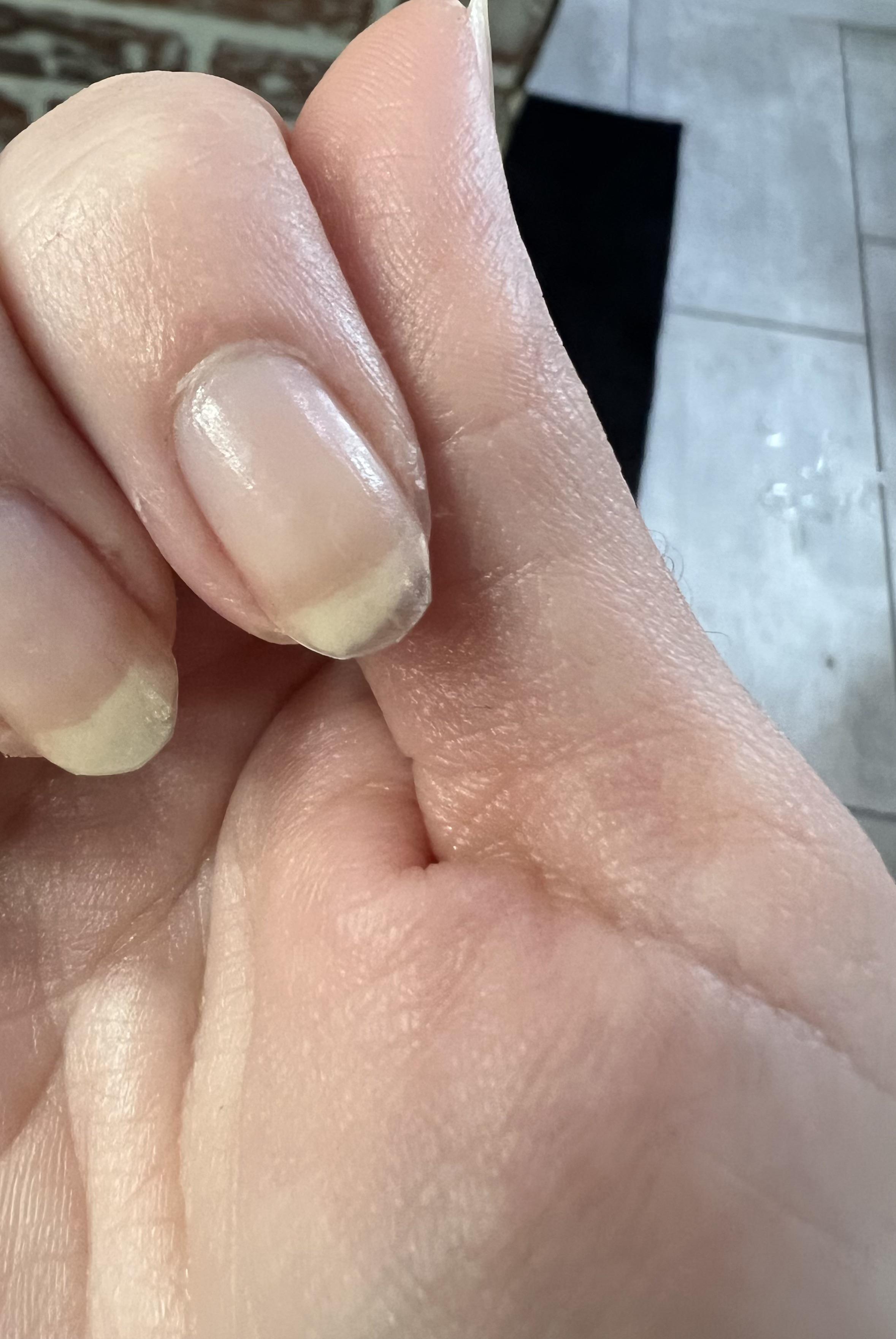 Why is part of my nail cloudy and part clear? Which part is healthy