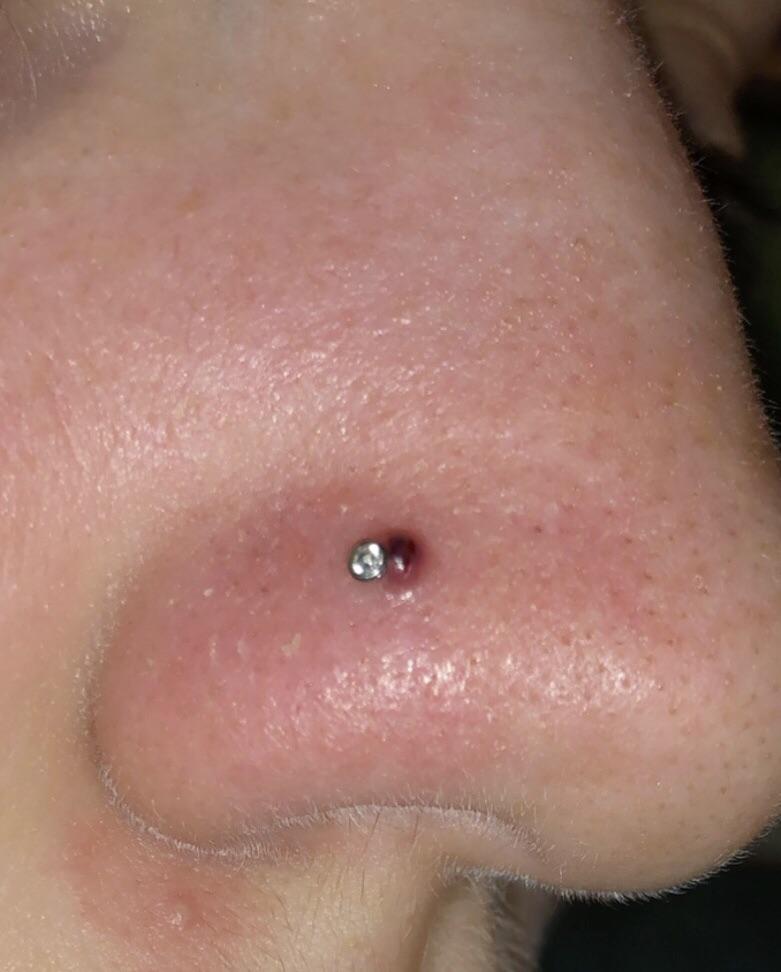 HELP!!! How do I get rid of my piercing bump? My nose piercing is 2