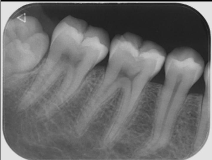 Hi, does any of these teeth have a cavity? My dentist said