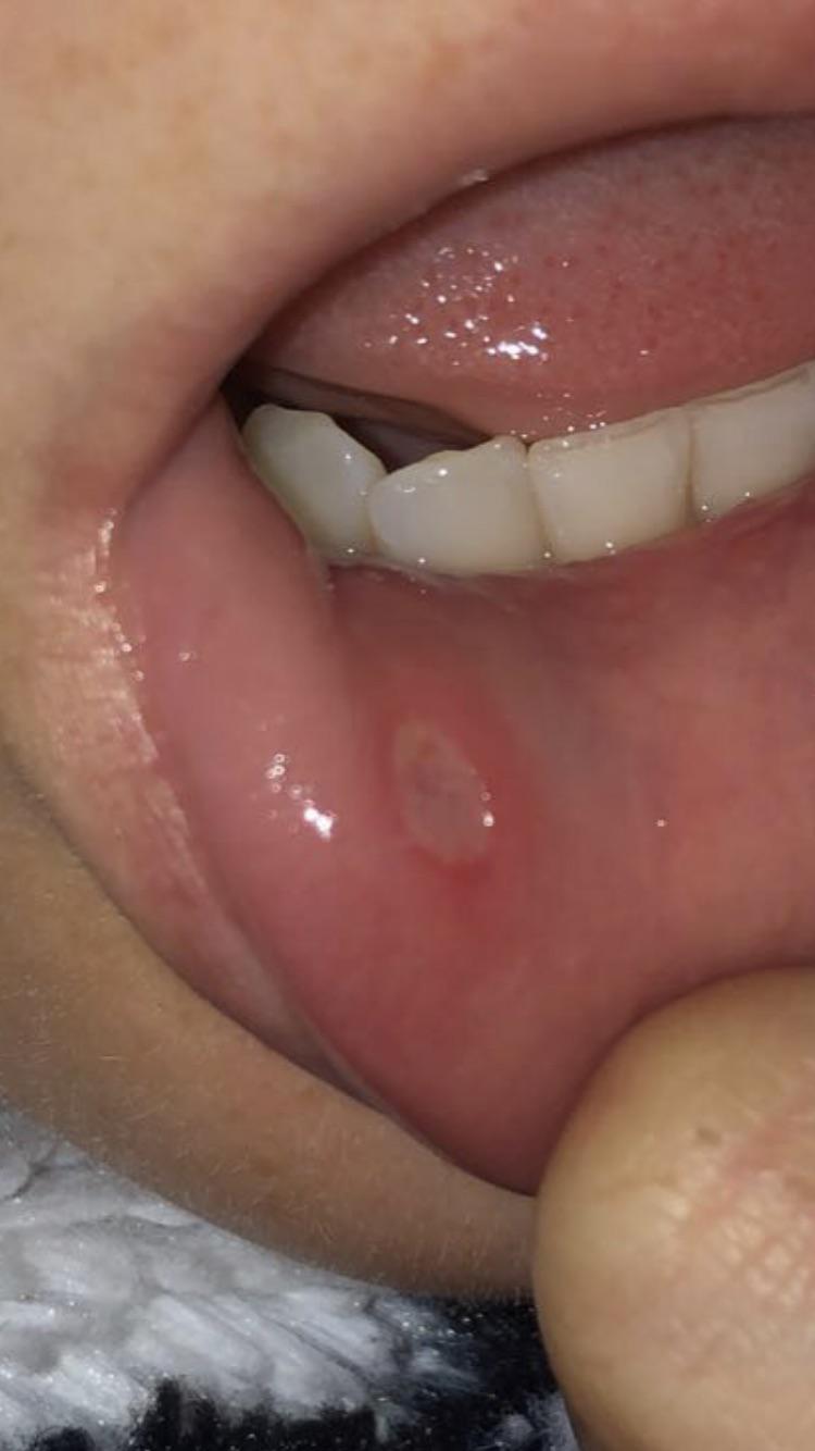 Is this an oral mouth wart or a cold sore? Warts