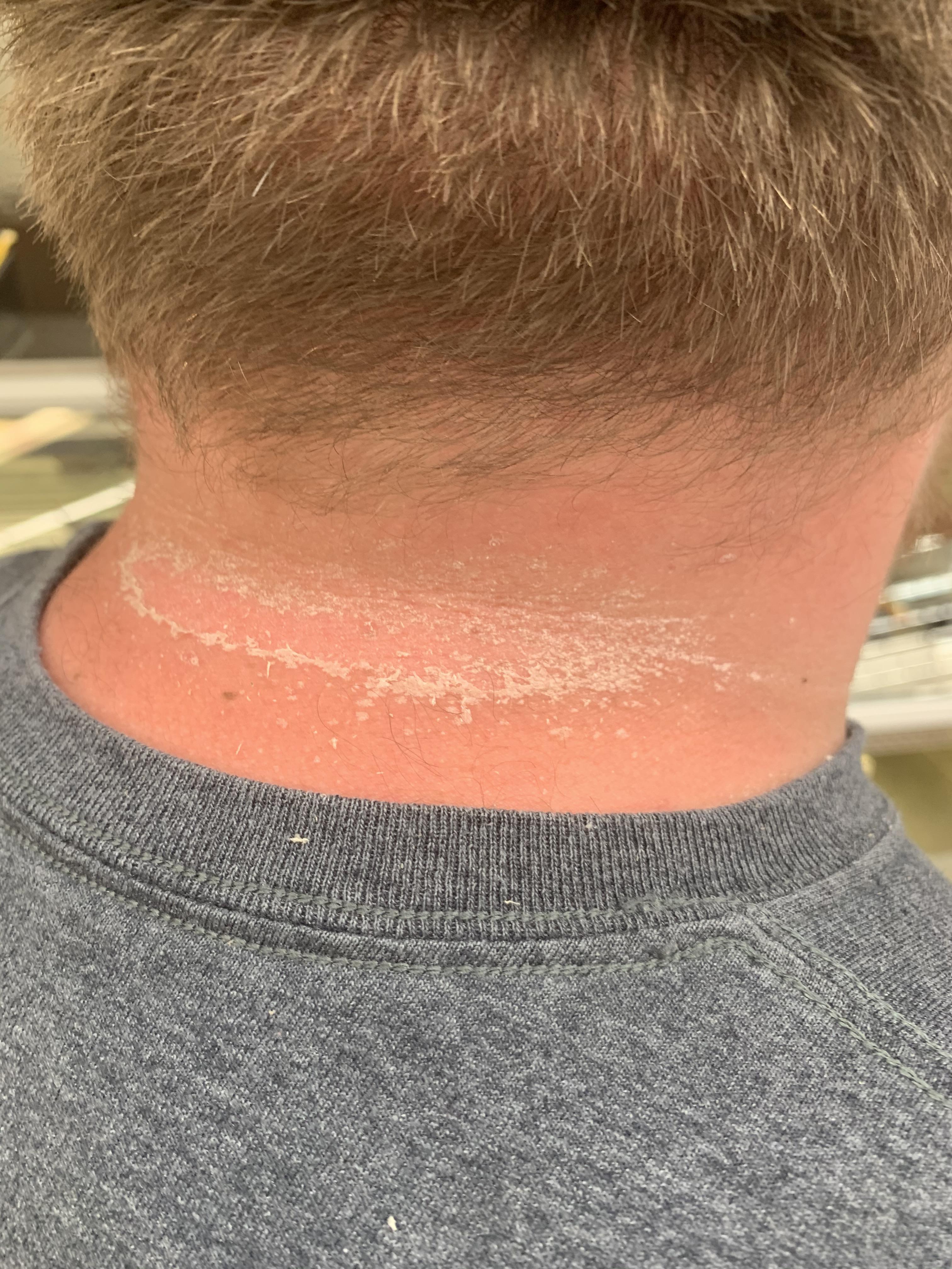 My husband’s sunburn... r/peeling