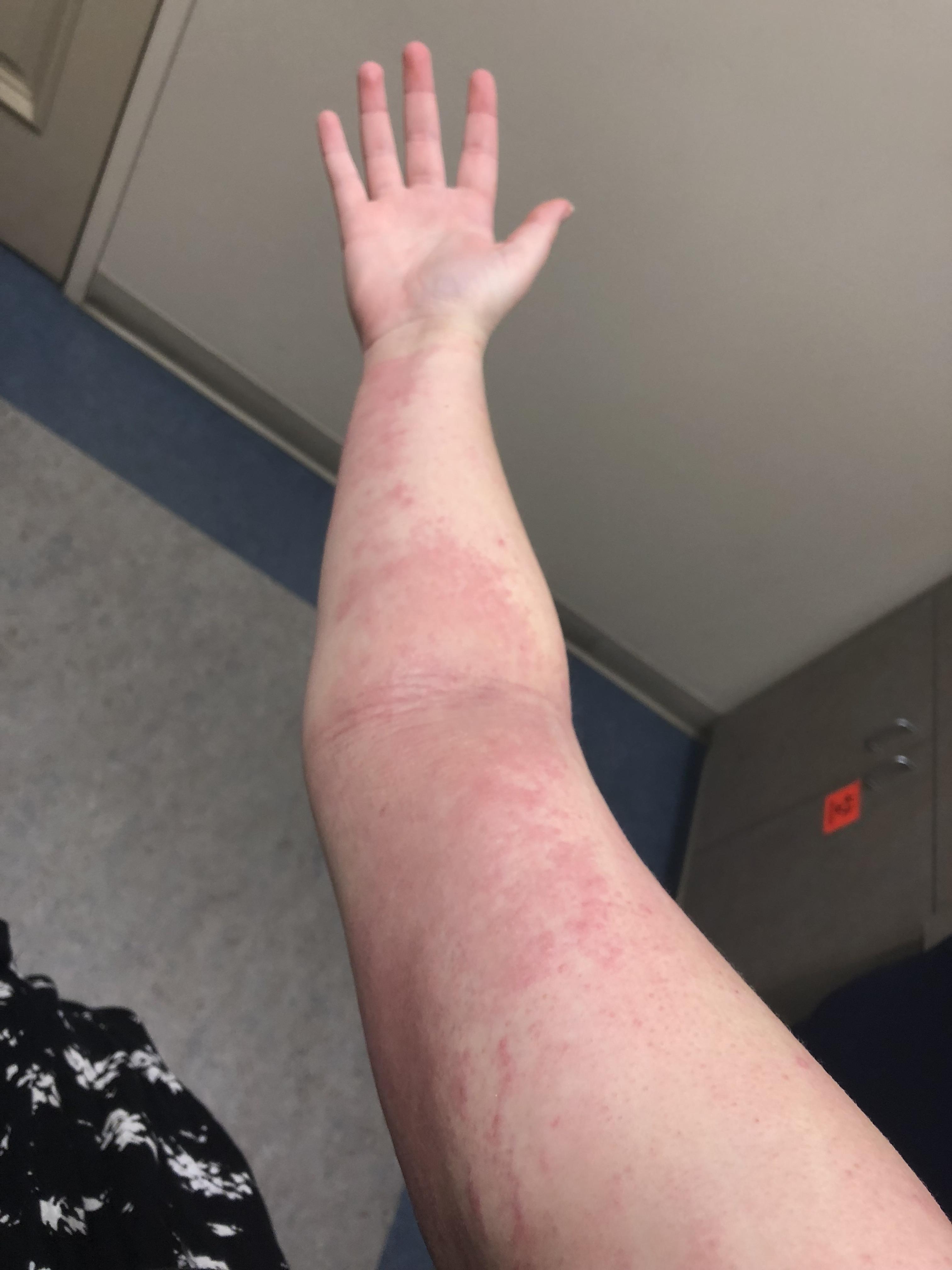 Finally at the dermatologist r/eczema