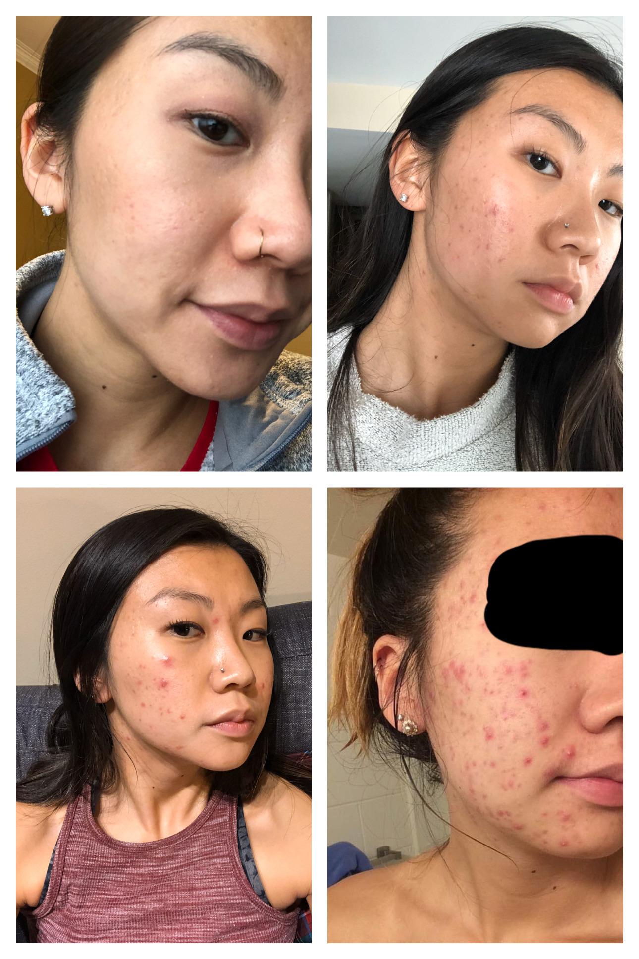 [Acne] Time for a before and after my skin was my biggest insecurity