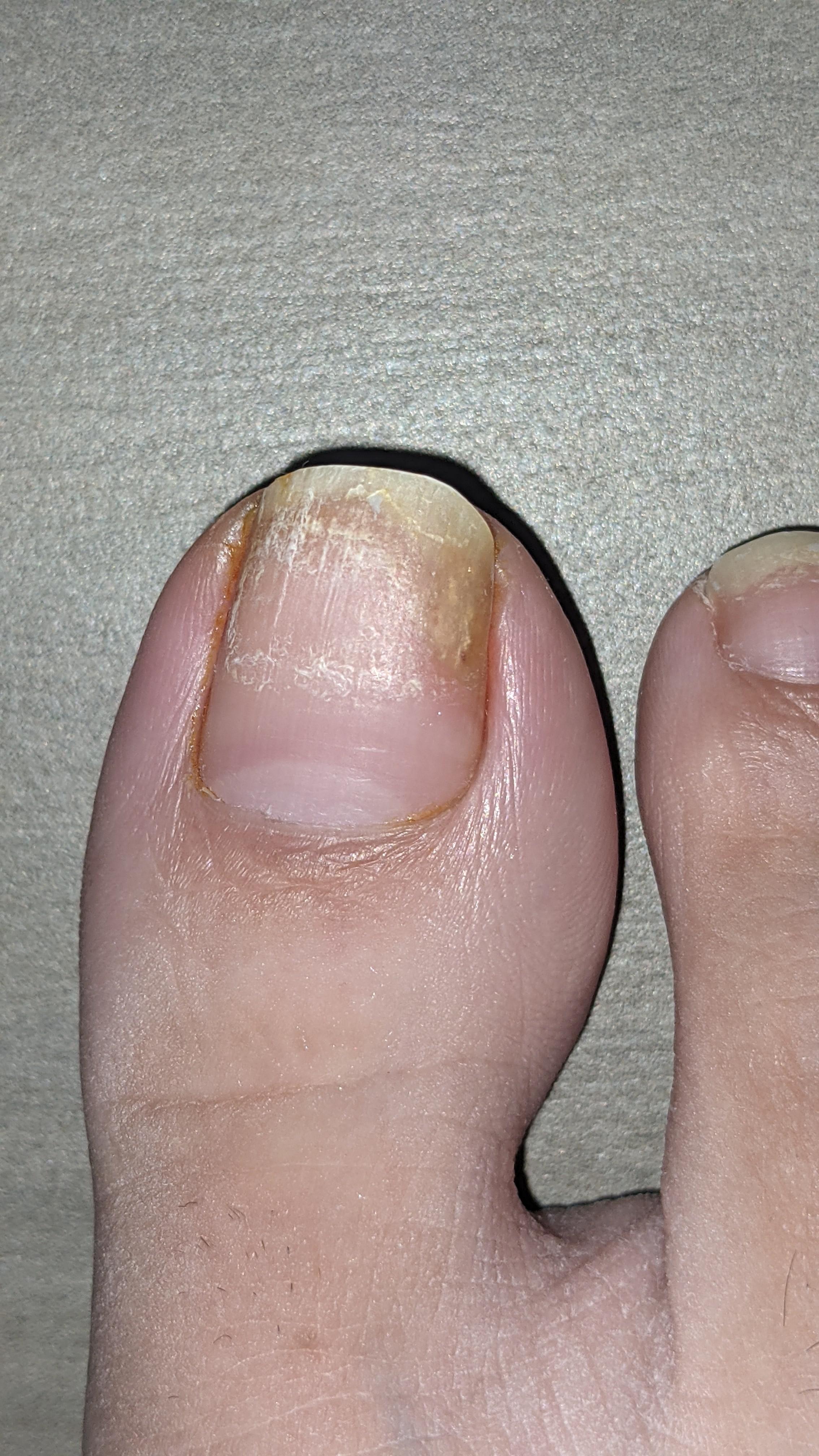 Nail fungus? Currently breastfeeding my newborn and can't use