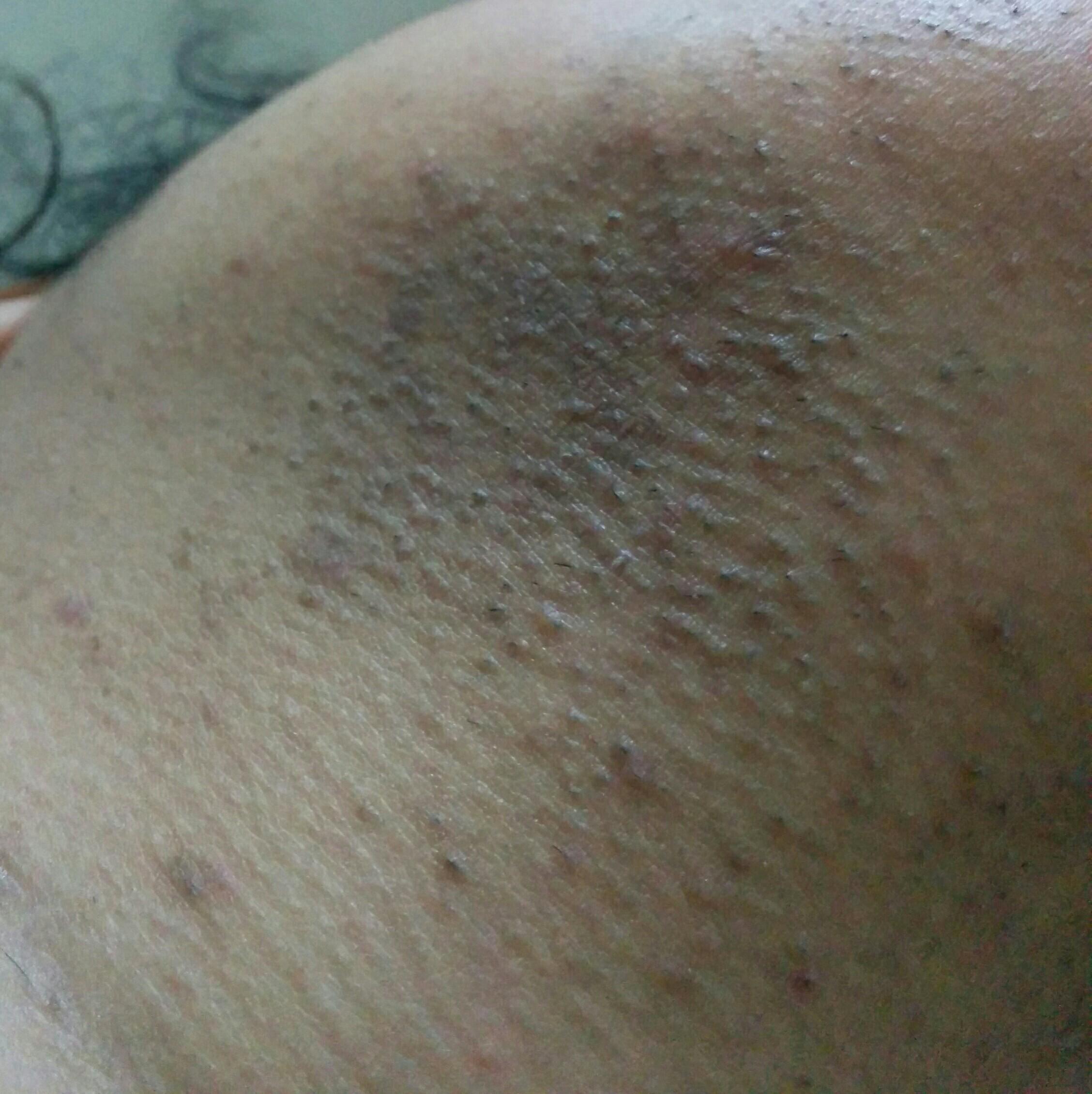 [Hair Removal]Pigmentation due to plucking chin hair for years. What do