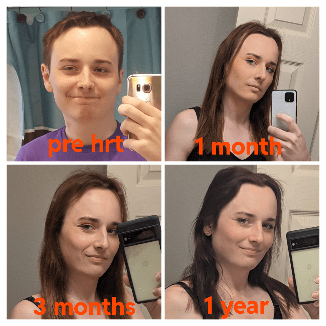 1 year hrt timeline of just face (25 MtF) r/transtimelines