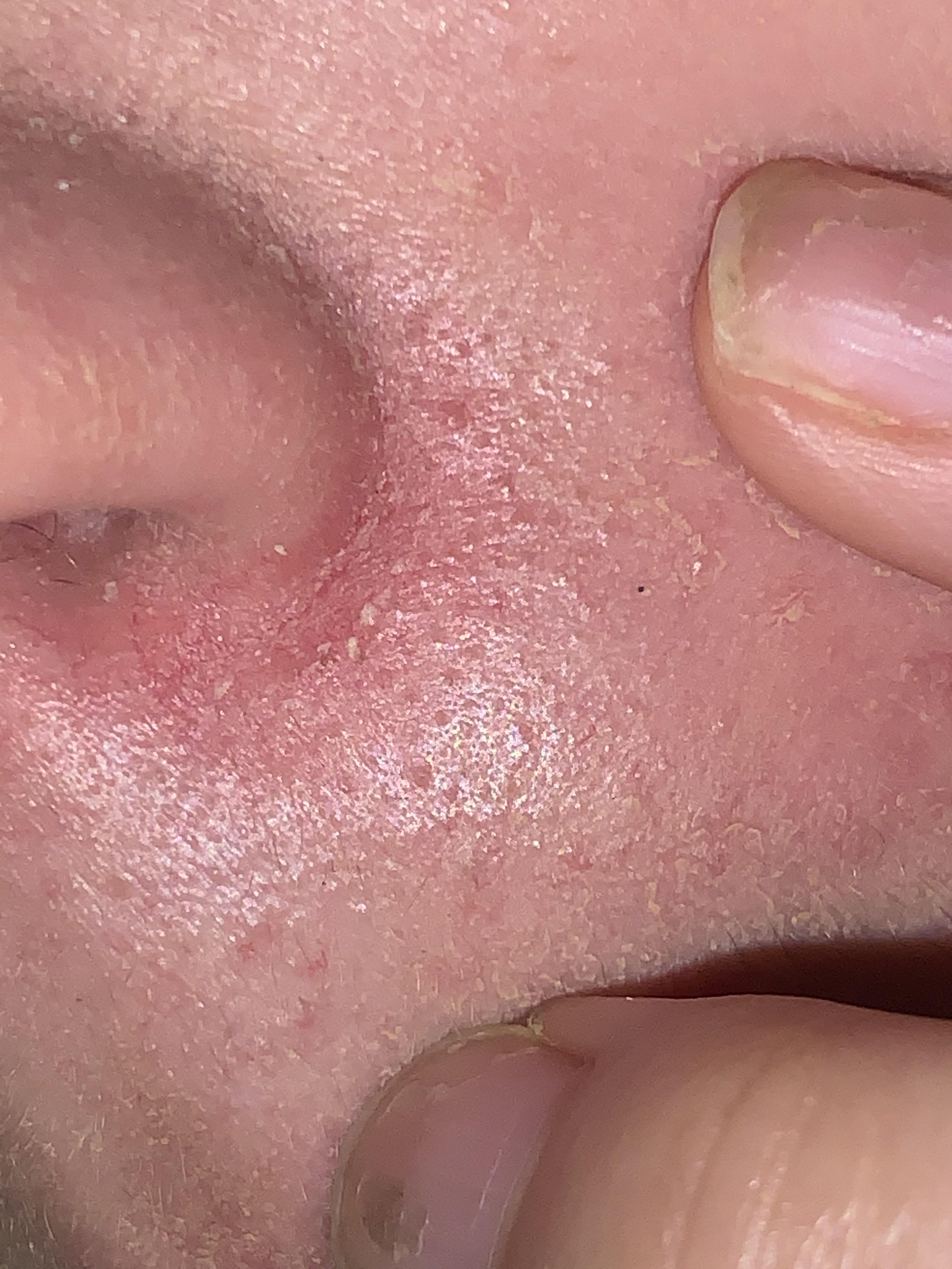 [Skin Concerns] INSANELY itchy dry skin in nose crevice—what could it