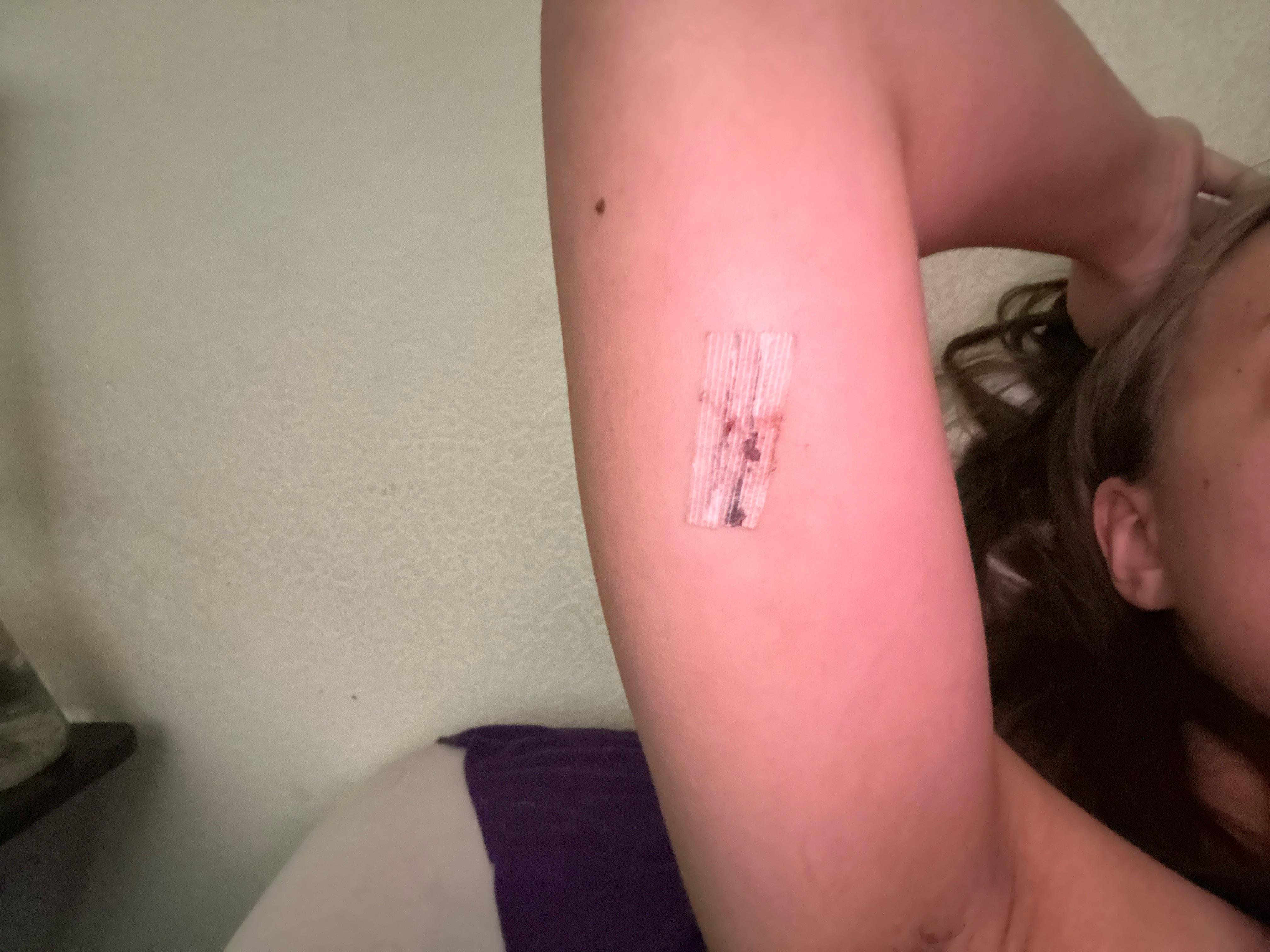 Nexplanon removal after nearly 6 years on it r/Nexplanon