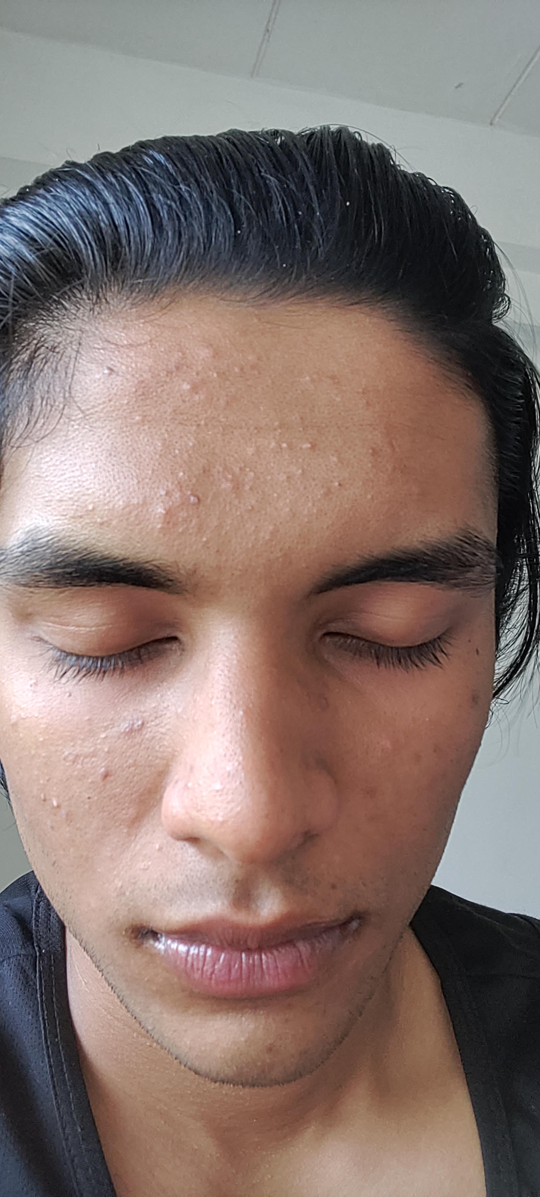 [Skin concerns] should I use ketoconazole for this if yes then how