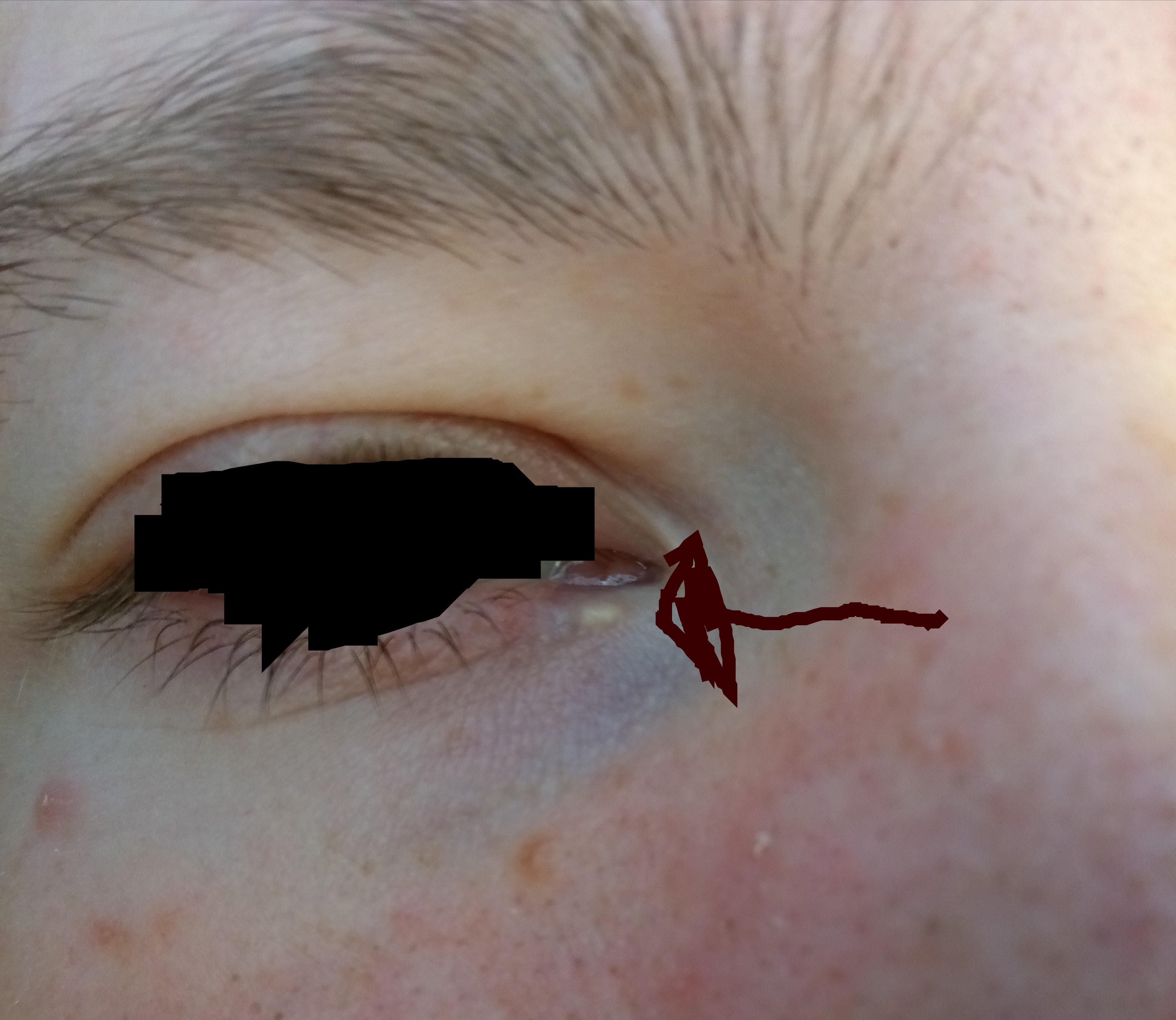 What is this thing under my eye? I've had it for 6 months to a year