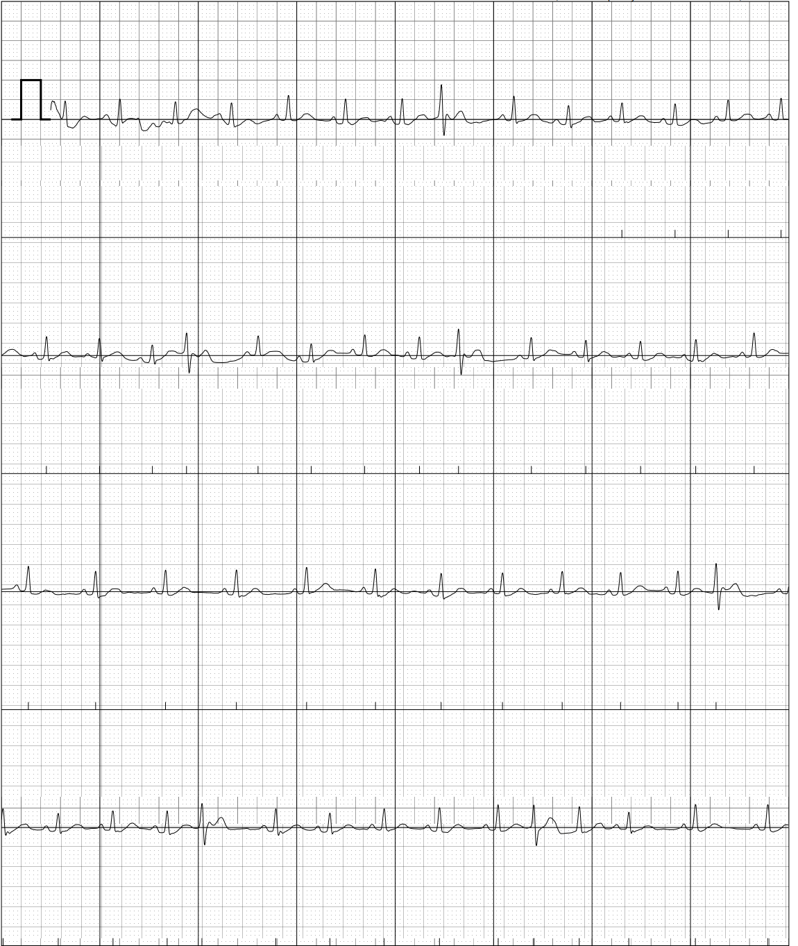 Can you tell whether they're PACs or PVCs here? Chance of them leading