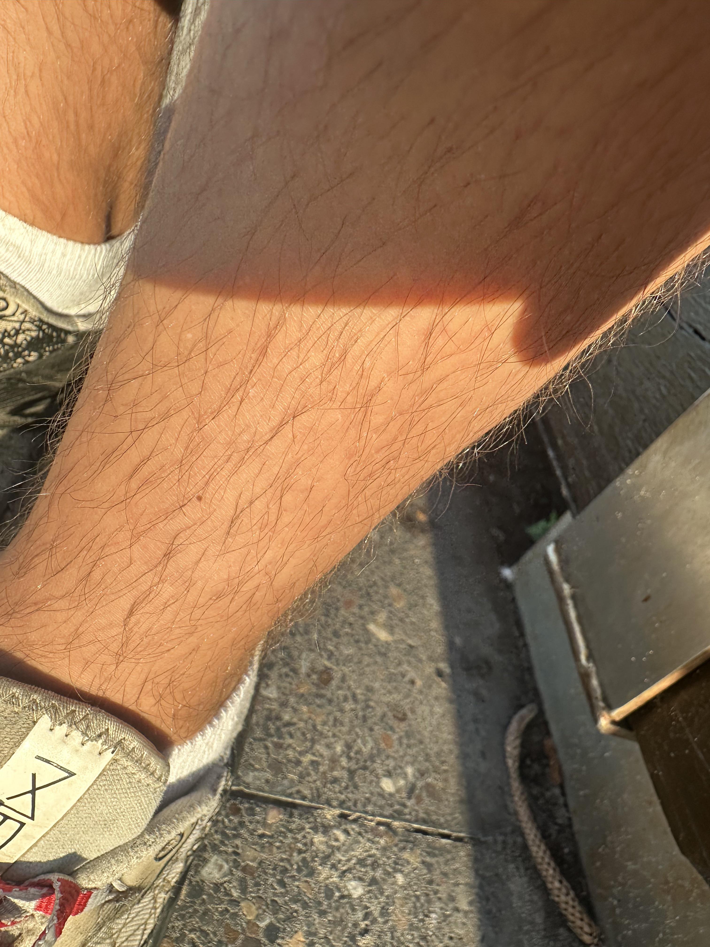 Bilateral lower leg pain when power walking/running. Symmetrical bumps on legs, looks venous