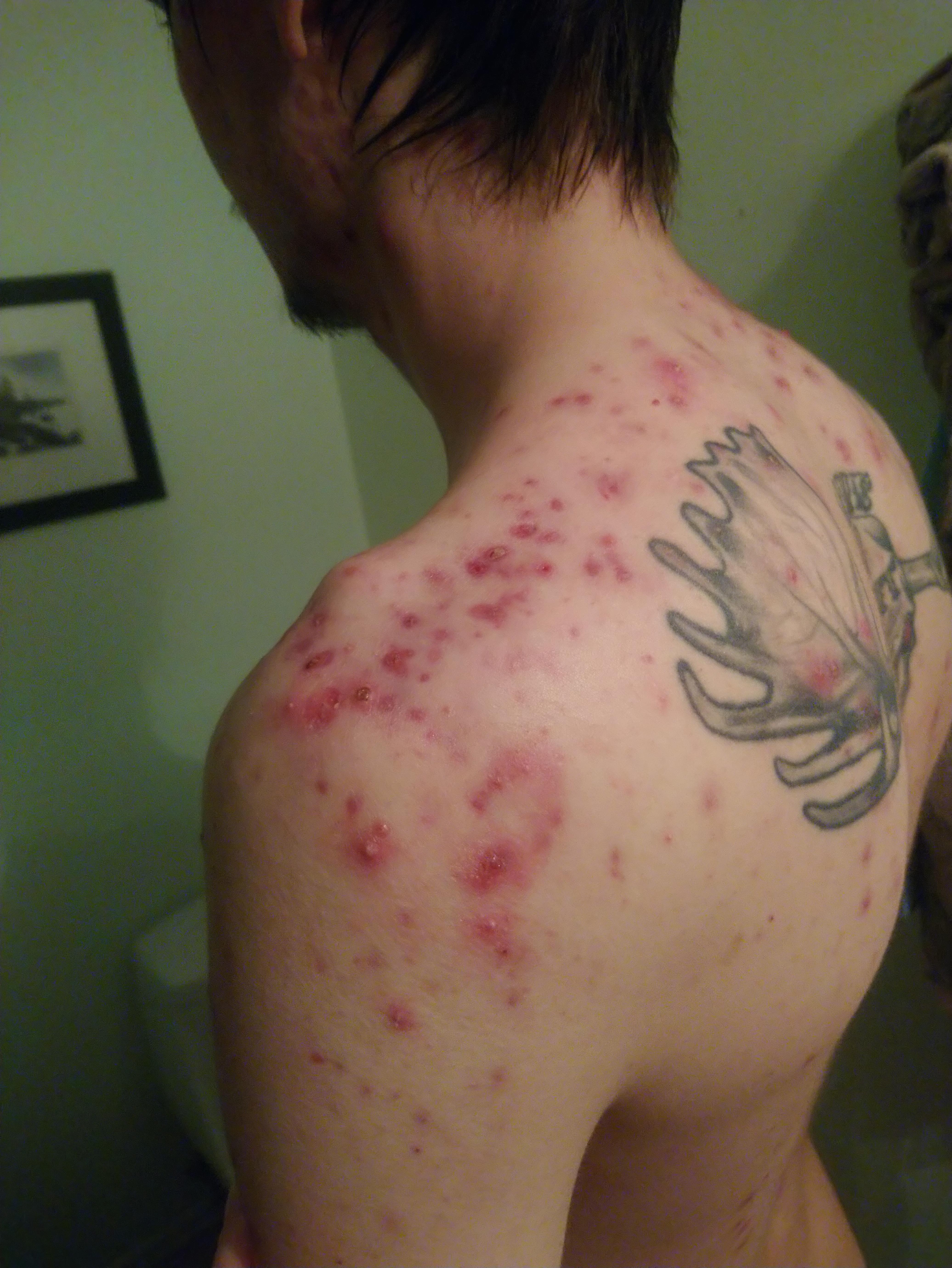is there a good solution for acne like this? also on his