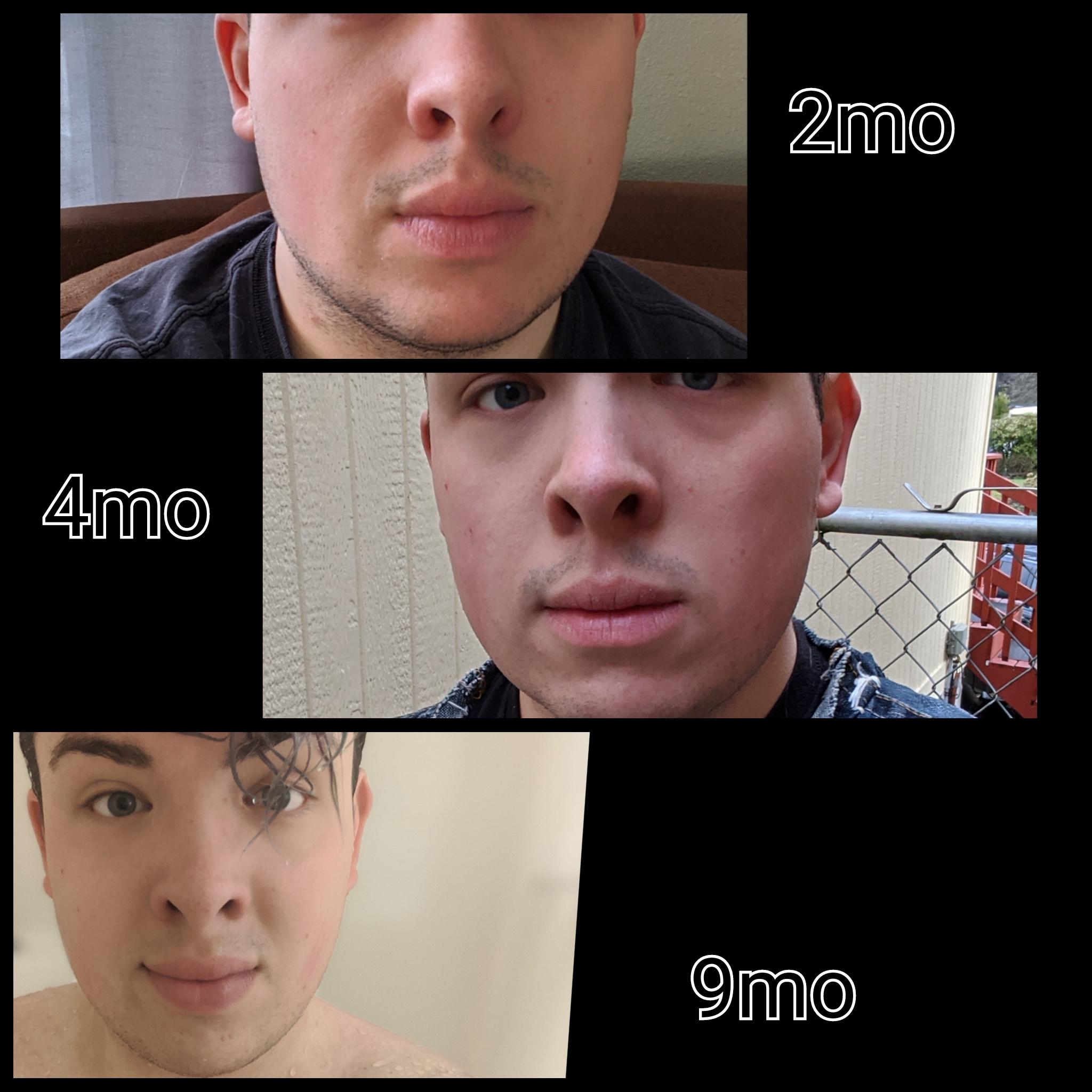 starting to see noticable changes in my face shape, and facial hair, 9mo hrt, mtf r/transtimelines