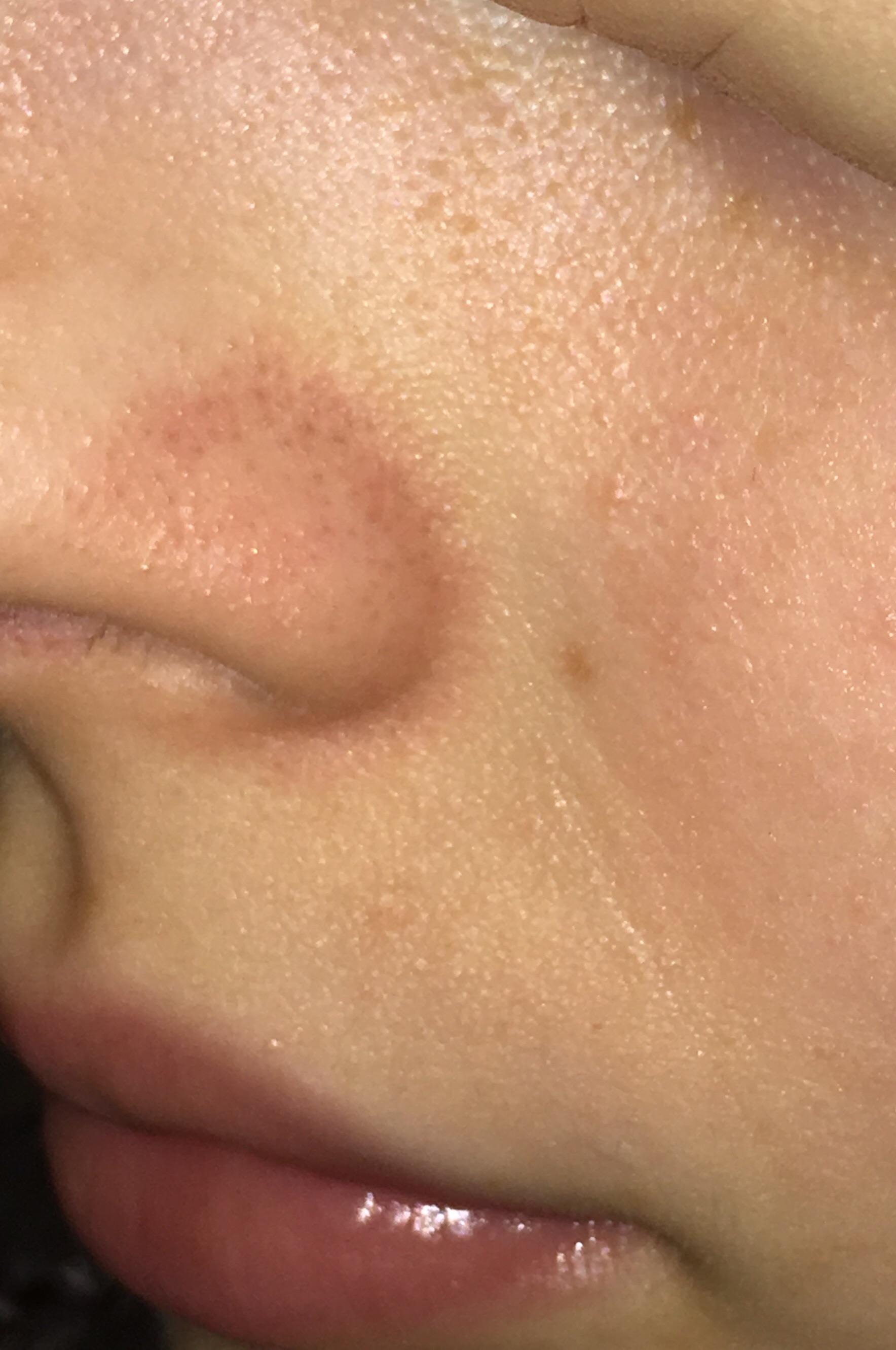 Redness around sides of nose for years. What’s causing this? I’ve tried