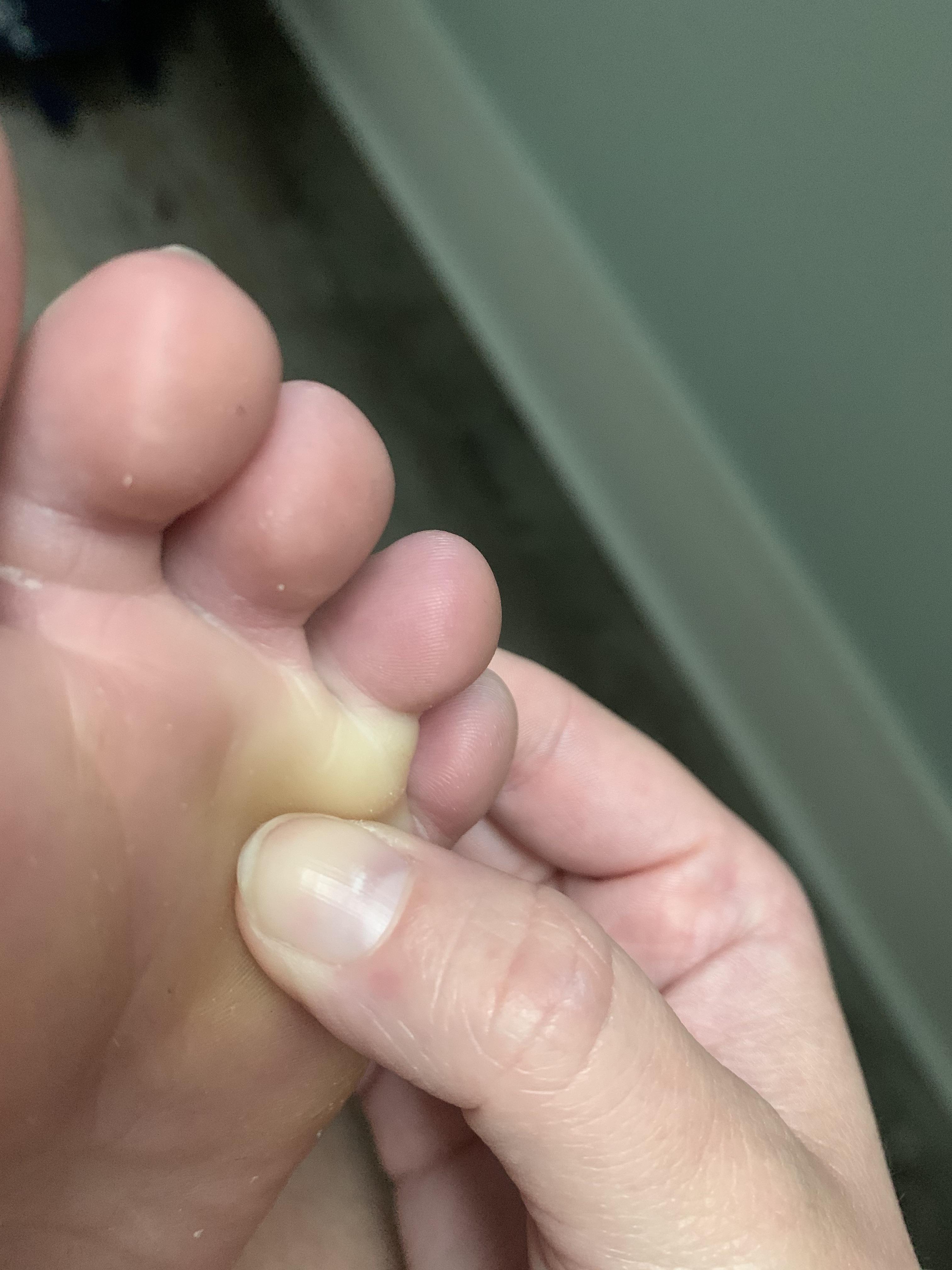 Painful hard lump underneath toe. Been there for a few months. r