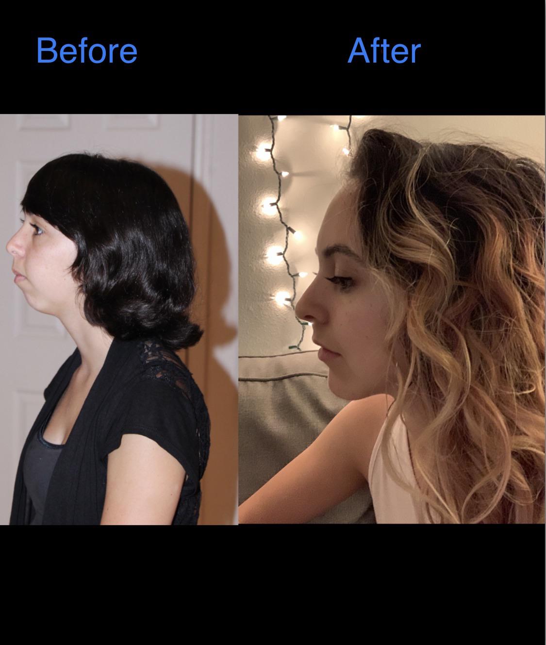 Results after double jaw surgery, sliding genioplasty, and lip filler