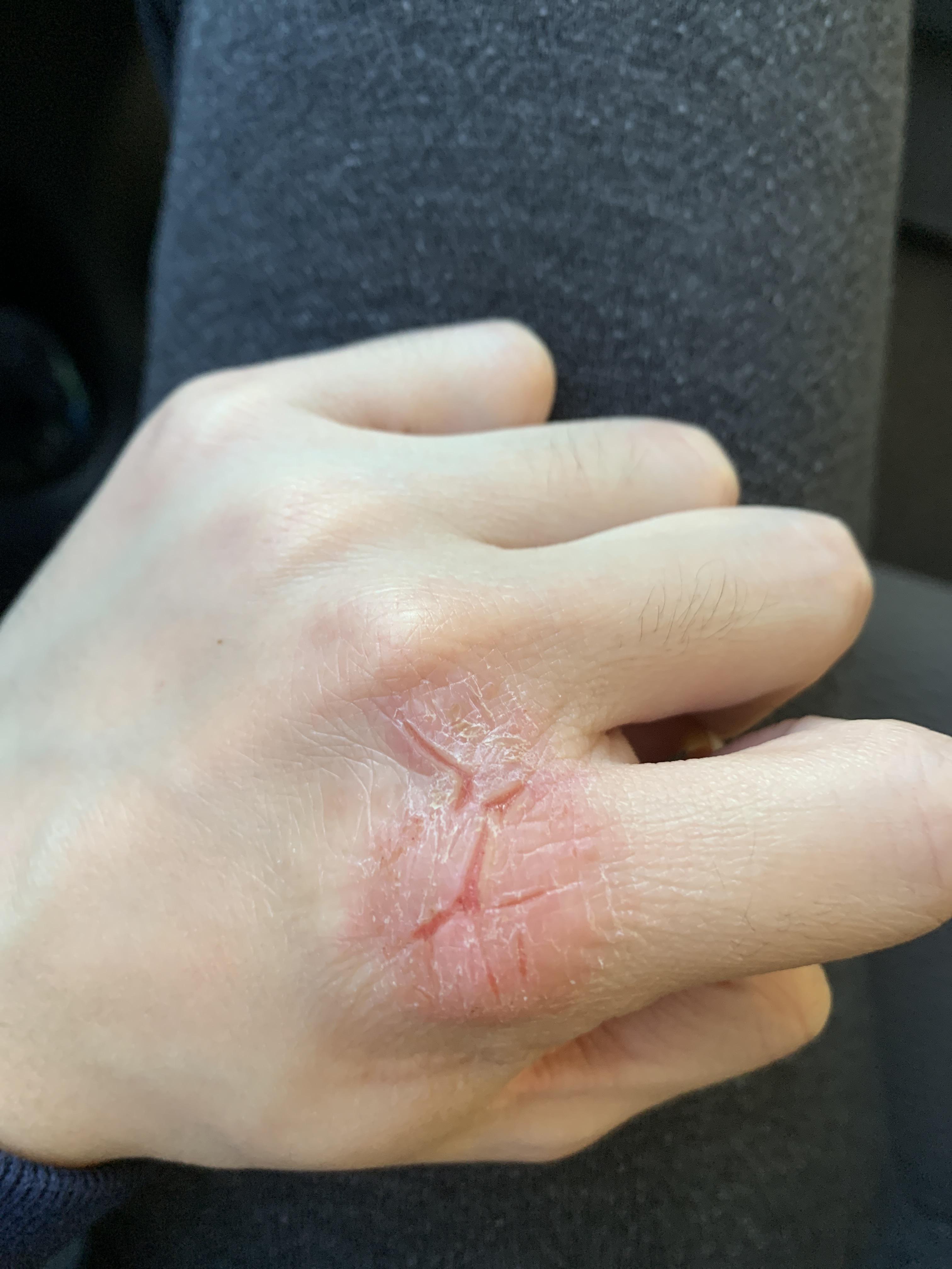 What are these big cracks on my knuckle? I think it’s eczema but just