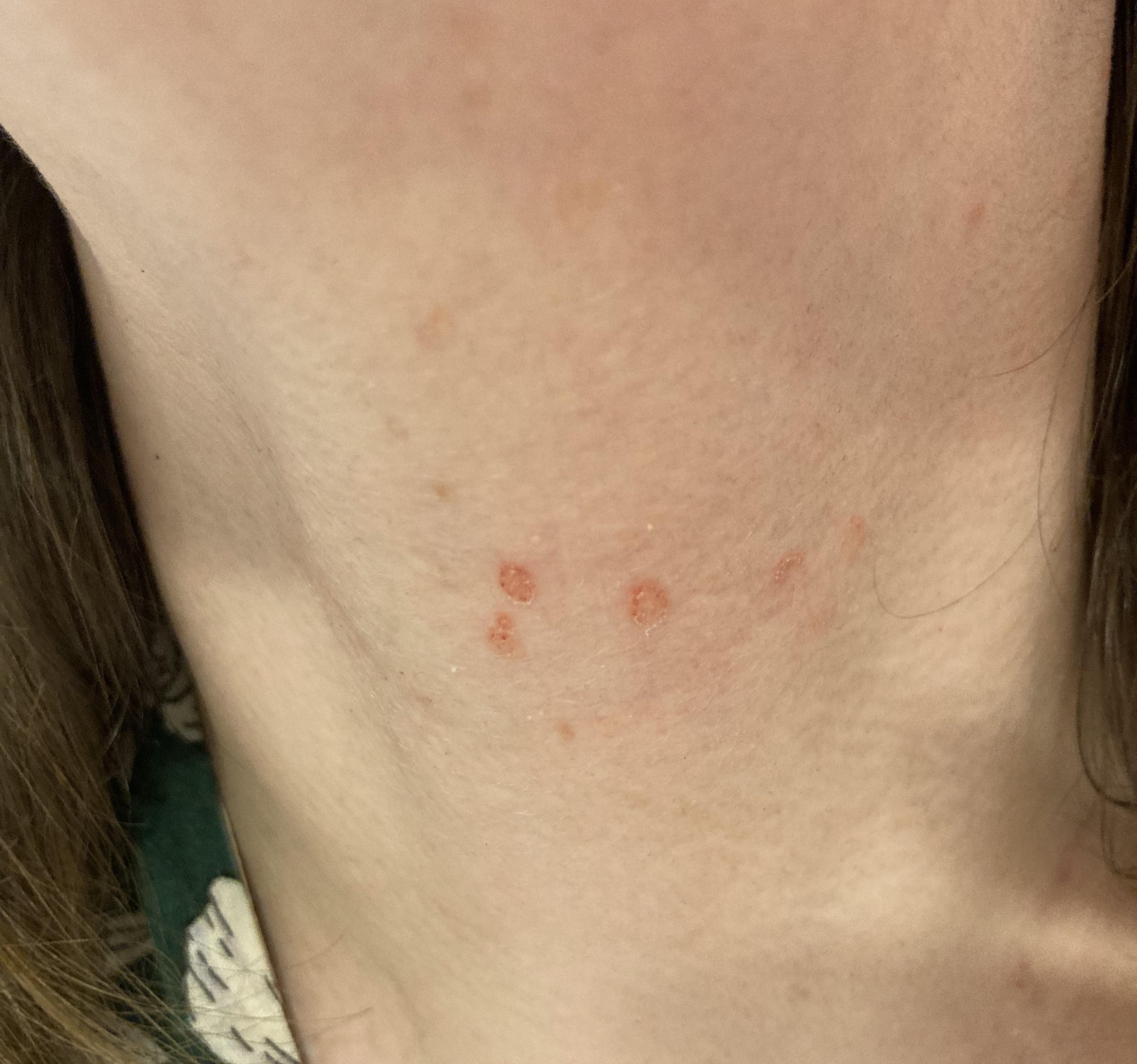 sudden red spots on neck r/DermatologyQuestions
