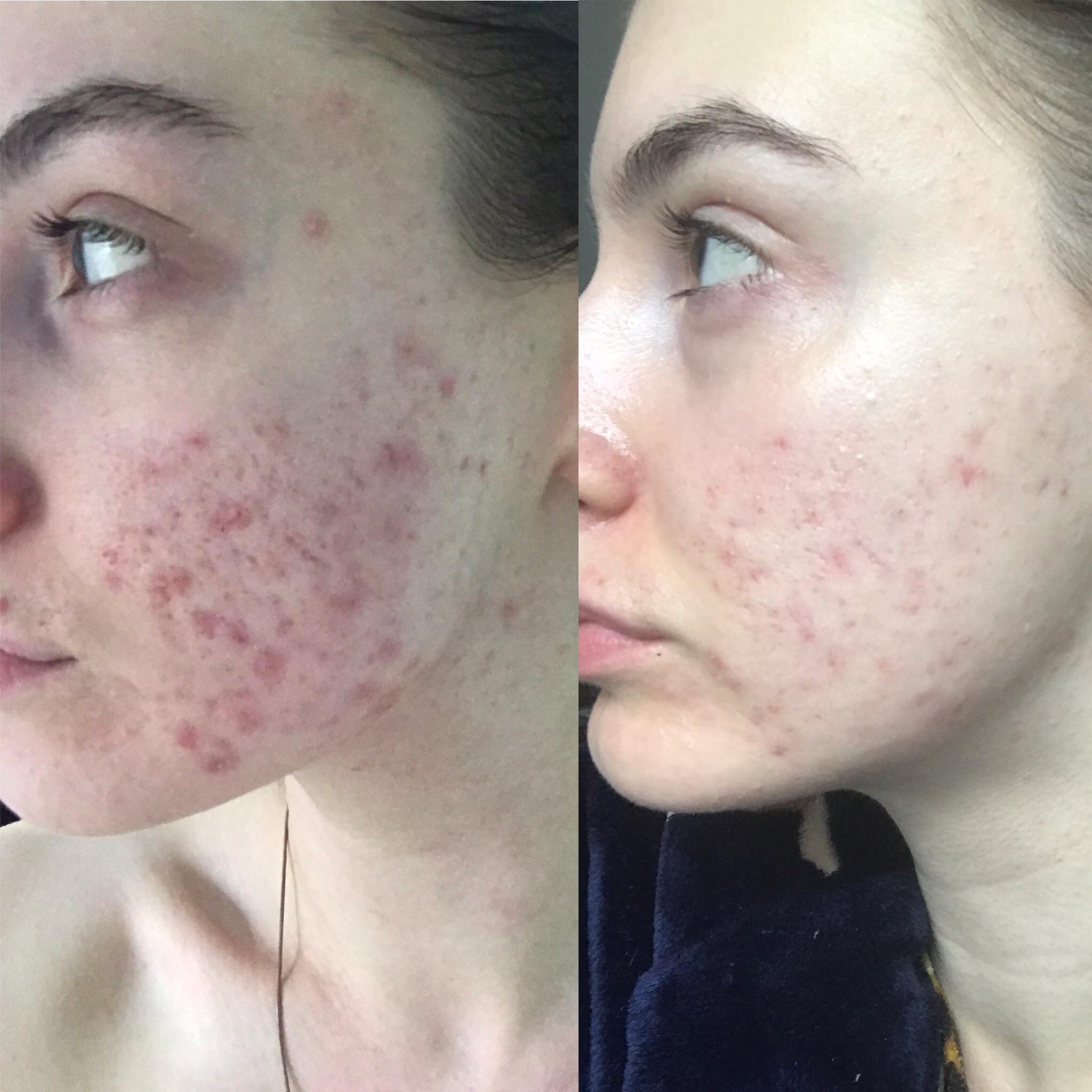 1 month of Tret 0.025/Niacinamide 4/Clindamycin 1. Buffered, twice