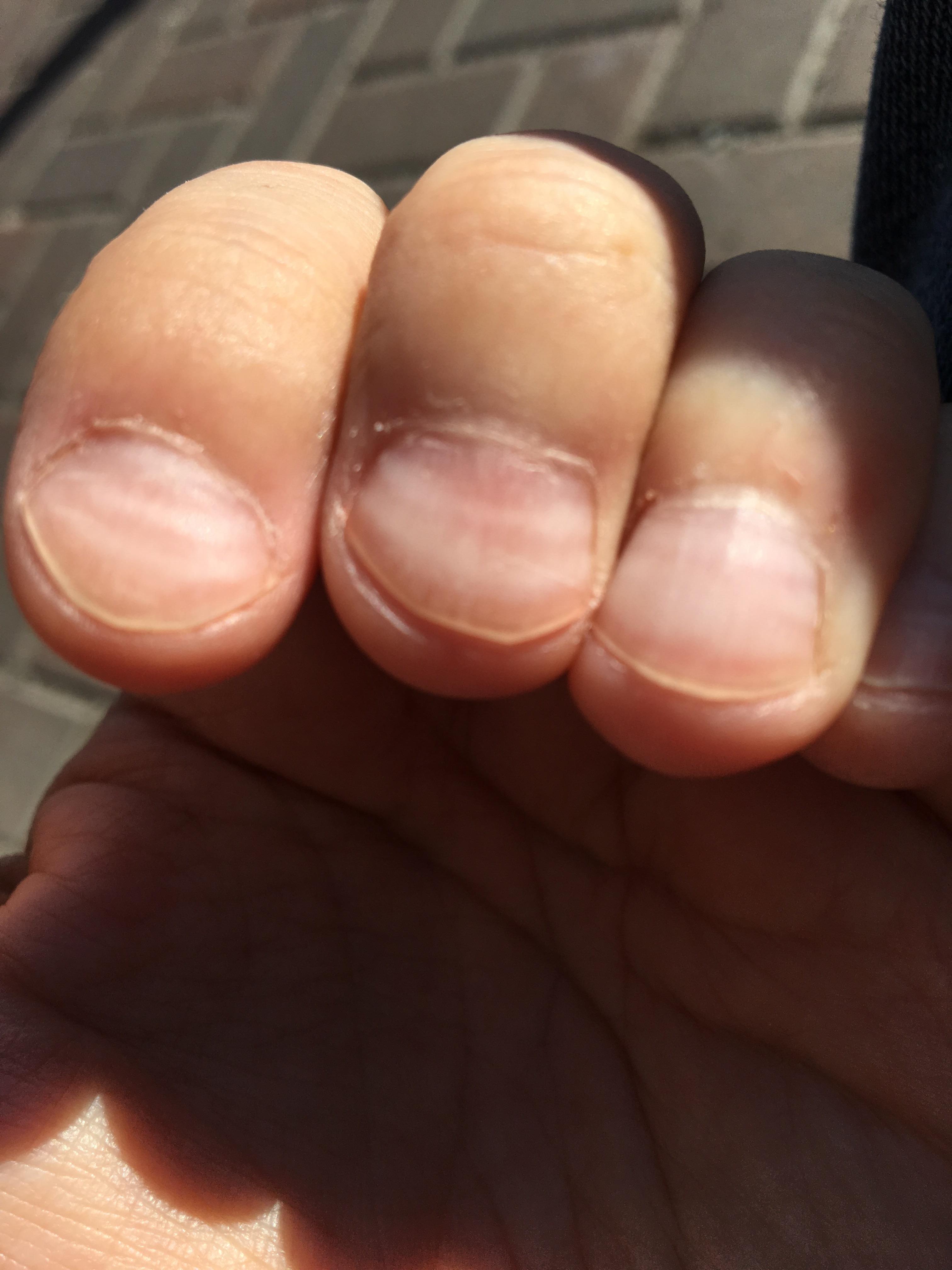 White ridges under finger nails? Possible related to chemotherapy or