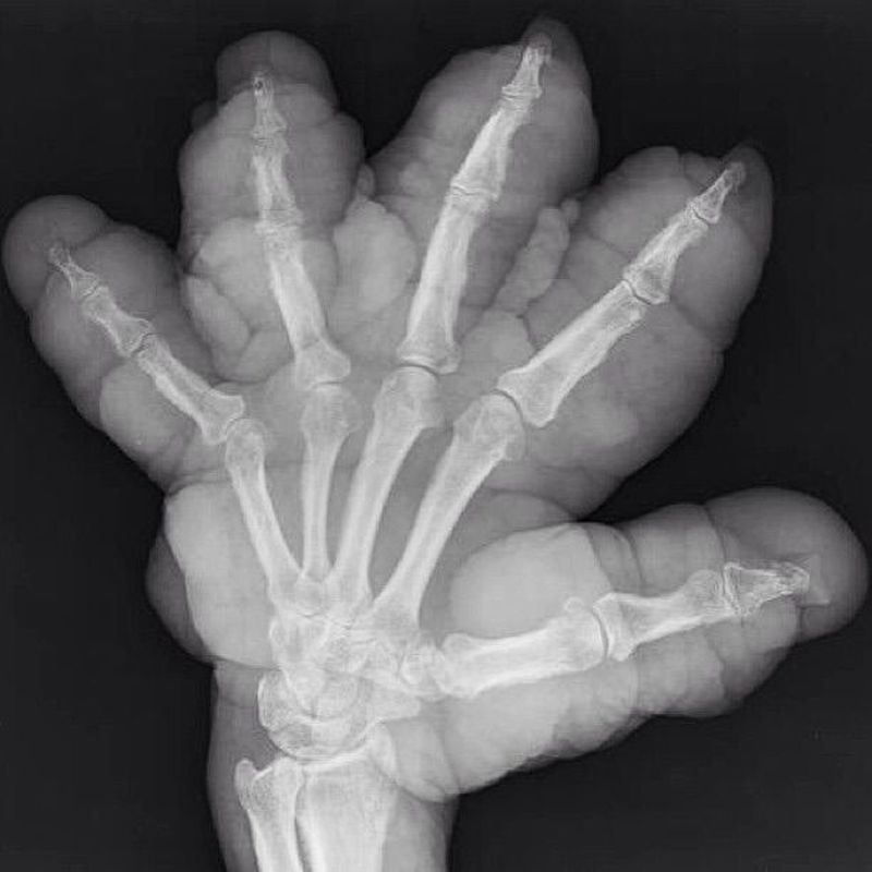 Thyroid acropachy is a rare consequence of autoimmune thyroid disease