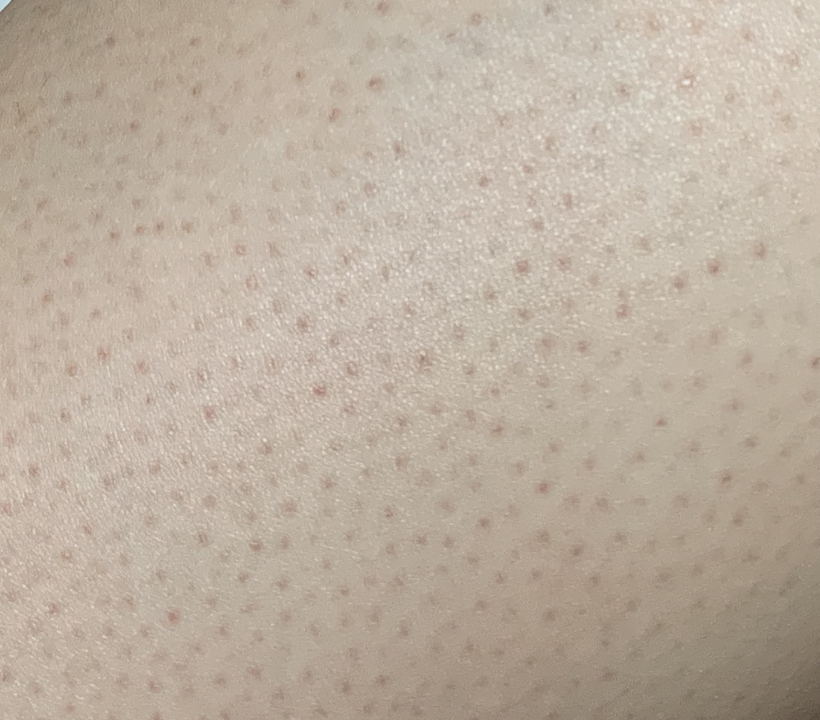 Strawberry legs advice? r/SkincareAddicts