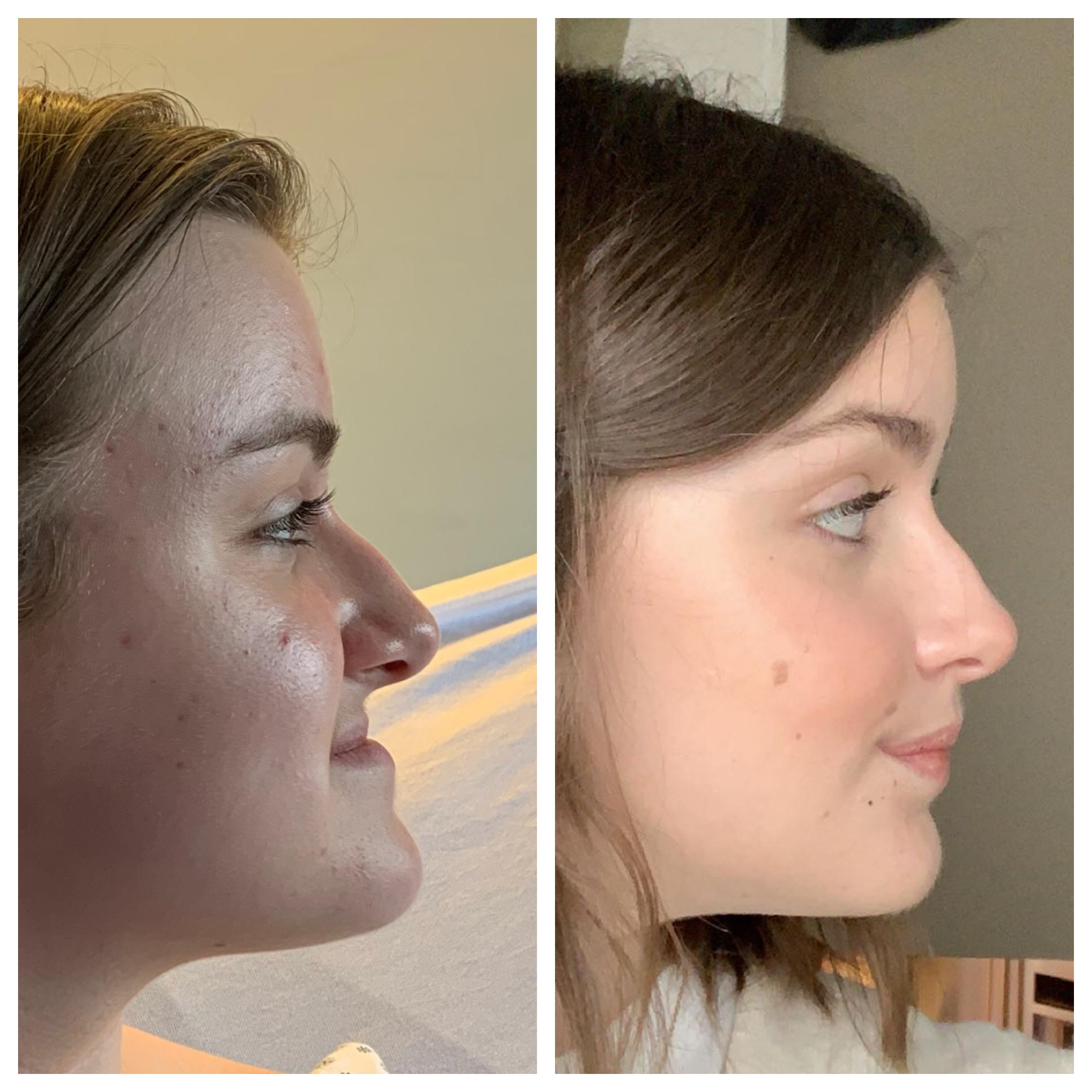 Septoplasty Before And After Reddit Aisuru Wallpaper