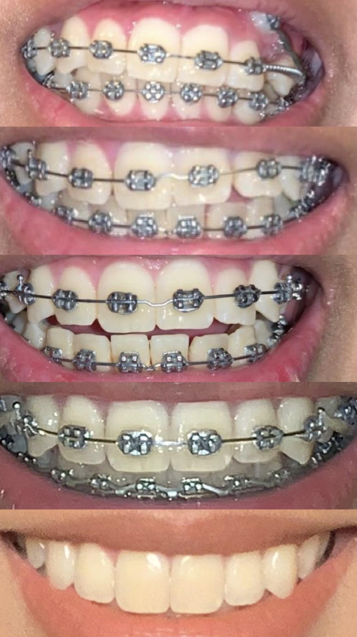 Finally got my TADs to fix my gummy smile. Looks really nasty, but it