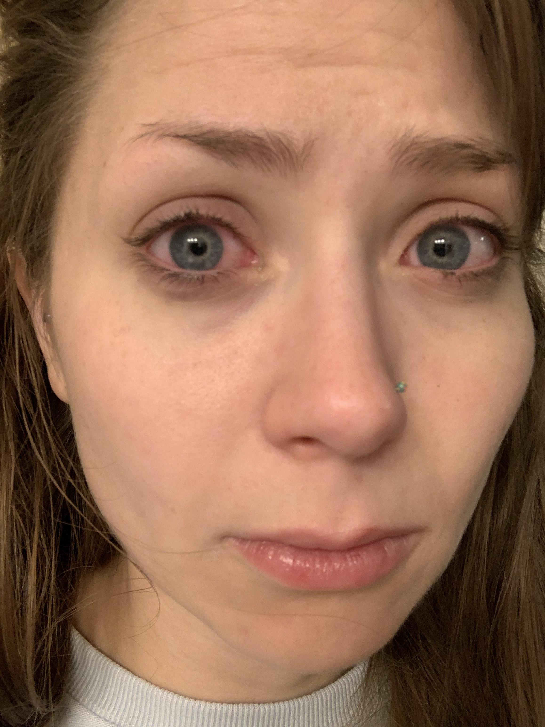 Does anyone else have really painfully dry eyes (esp in the morning