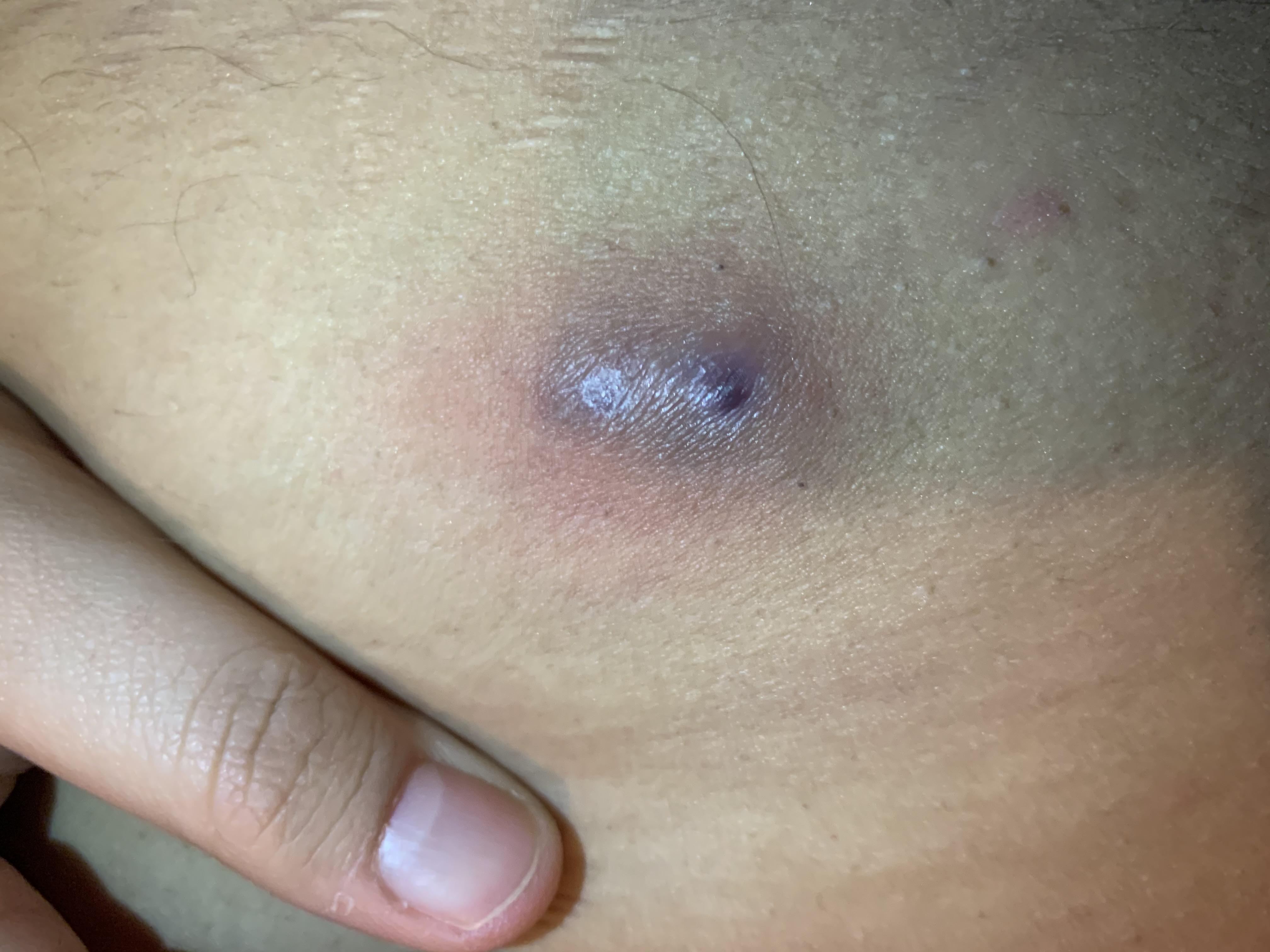 Lump near the groin on my thigh (F20) medical_advice