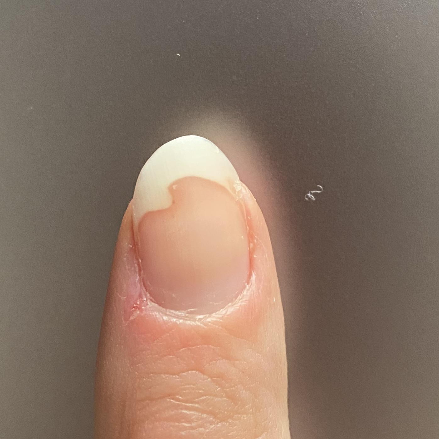 Smashed my finger in a door 2 months ago. Just curious—will it keep